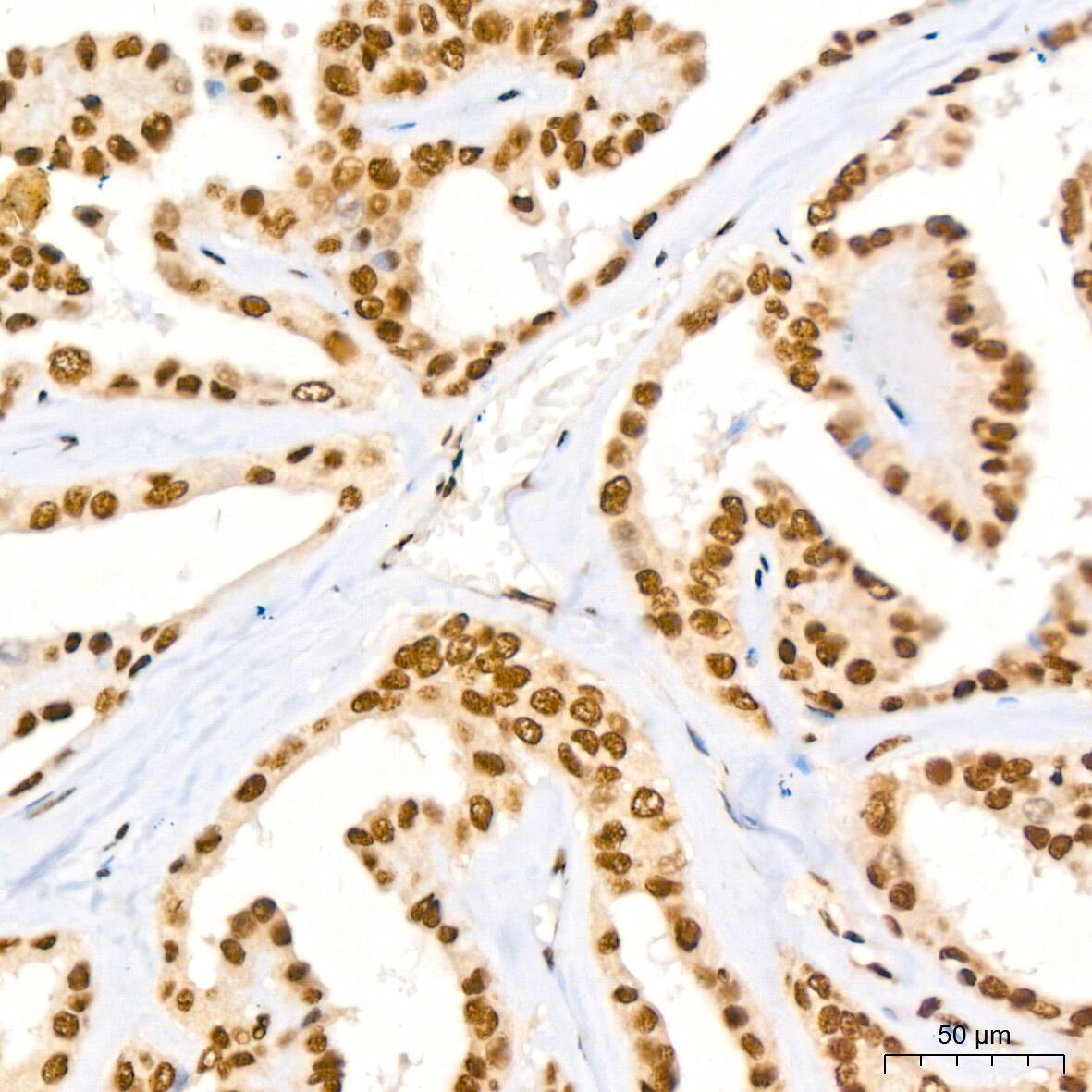 Immunohistochemistry: NuMA Antibody (6D4I4) [NBP3-16411] - Immunohistochemistry analysis of NuMA in paraffin-embedded human thyroid cancer tissue using NuMA Rabbit mAb  at a dilution of 1:200 (40x lens).High pressure antigen retrieval was performed with 0.01 M citrate buffer (pH 6.0) prior to IHC staining.