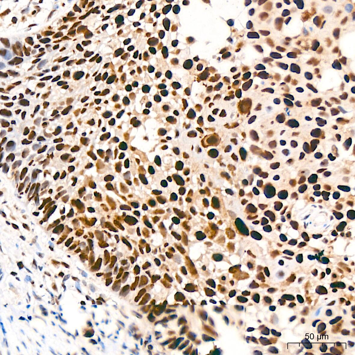 Immunohistochemistry: KAT1 Antibody (7U2O3) [NBP3-16412] - Immunohistochemistry analysis of KAT1 in paraffin-embedded human cervix cancer tissue using KAT1 Rabbit mAb  at a dilution of 1:200 (40x lens).High pressure antigen retrieval was performed with 0.01 M citrate buffer (pH 6.0) prior to IHC staining.