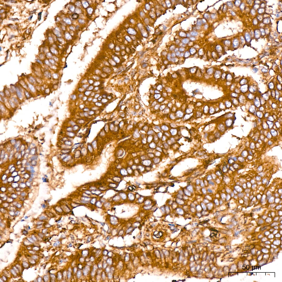 Immunohistochemistry: ACTR3 Antibody (8K4F2) [NBP3-16424] - Immunohistochemistry analysis of ACTR3 in paraffin-embedded human colon carcinoma tissue using ACTR3 Rabbit mAb  at a dilution of 1:200 (40x lens).High pressure antigen retrieval was performed with 0.01 M citrate buffer (pH 6.0) prior to IHC staining.