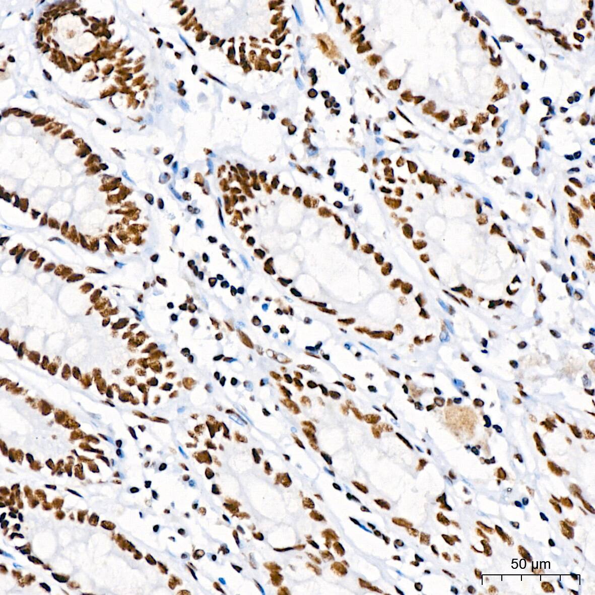 Immunohistochemistry: RNA Helicase A Antibody (2I6C5) [NBP3-16435] - Immunohistochemistry analysis of paraffin-embedded Human colon using RNA Helicase A Rabbit mAb at dilution of 1:200 (40x lens). High pressure antigen retrieval performed with 0.01M Citrate Bufferr (pH 6.0) prior to IHC staining.