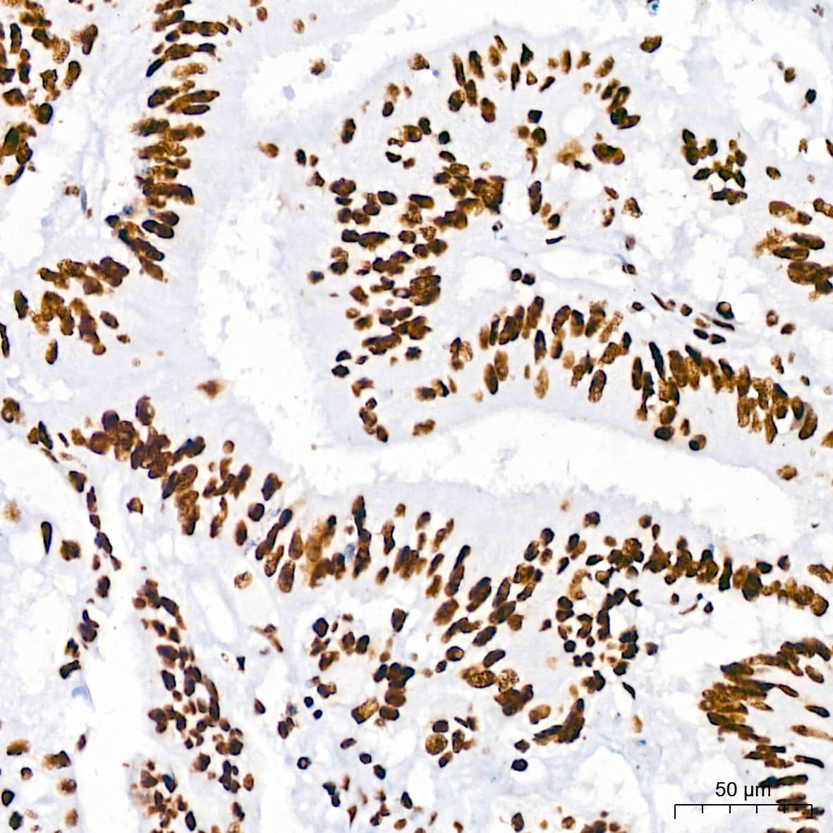 Immunohistochemistry: RNA Helicase A Antibody (2I6C5) [NBP3-16435] - Immunohistochemistry analysis of paraffin-embedded Human colon carcinoma using RNA Helicase A Rabbit mAb at dilution of 1:200 (40x lens). High pressure antigen retrieval performed with 0.01M Citrate Bufferr (pH 6.0) prior to IHC staining.