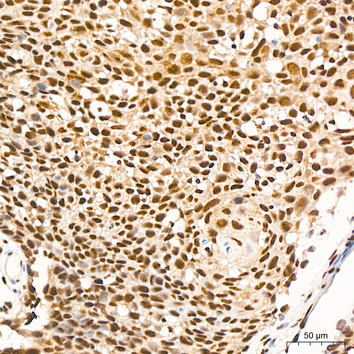 Immunohistochemistry: PRPF8 Antibody (4I1Q8) [PRPF8] - Immunohistochemistry analysis of PRPF8 in paraffin-embedded human cervix cancer tissue using PRPF8 Rabbit mAb  at a dilution of 1:200 (40x lens). High pressure antigen retrieval was performed with 0.01 M citrate buffer (pH 6.0) prior to IHC staining.