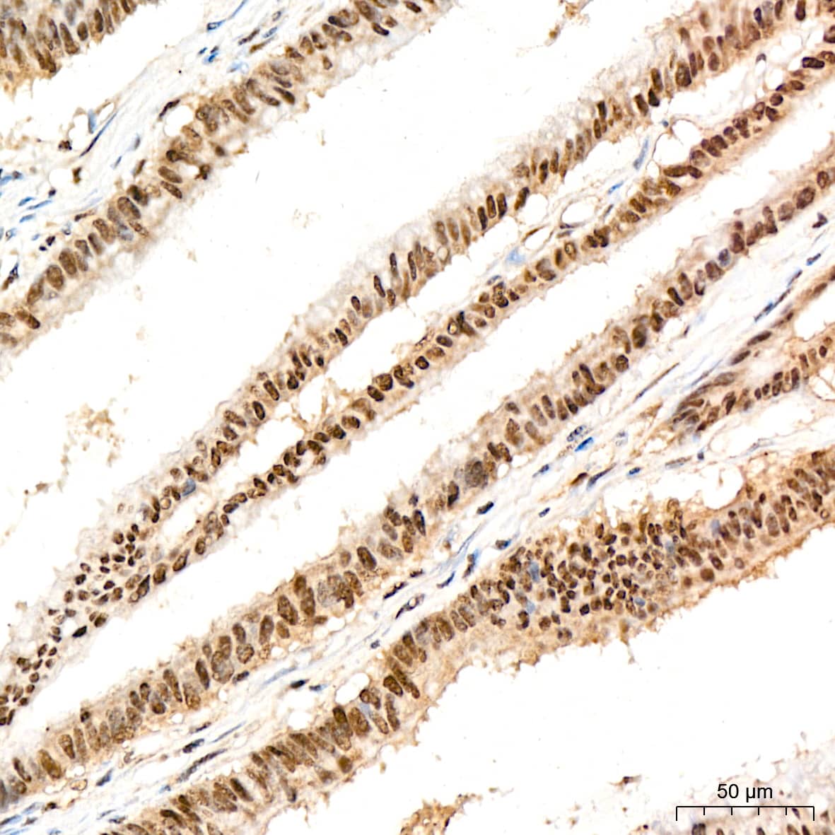 Immunohistochemistry: PRPF8 Antibody (4I1Q8) [NBP3-16440] - Immunohistochemistry analysis of PRPF8 in paraffin-embedded human colon carcinoma tissue using PRPF8 Rabbit mAb  at a dilution of 1:200 (40x lens). High pressure antigen retrieval was performed with 0.01 M citrate buffer (pH 6.0) prior to IHC staining.