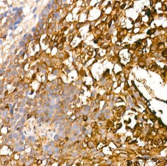 Immunohistochemistry-Paraffin: Involucrin Antibody (8H7B3) [NBP3-15461] -Human cervix cancer tissue using Involucrin Rabbit mAb at a dilution of 1:200 (40x lens). High pressure antigen retrieval performed with 0.01M Citrate Bufferr (pH 6.0) prior to IHC staining.