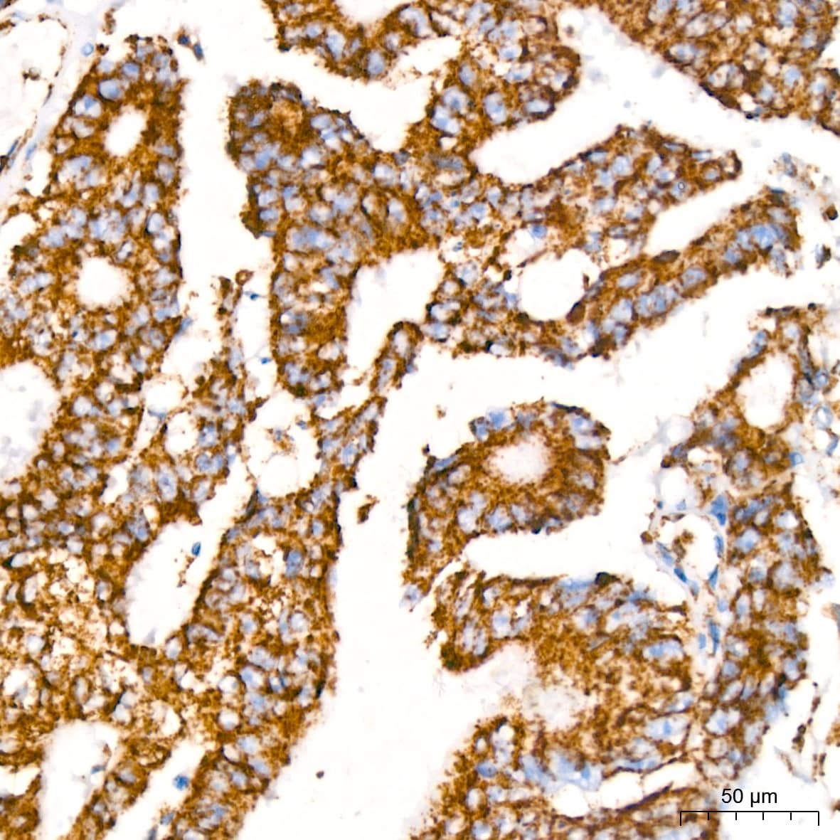 Immunohistochemistry: PBR Antibody (4I9K6) [NBP3-16497] - Immunohistochemistry analysis of paraffin-embedded Human colon carcinoma tissue using PBR Rabbit mAb at a dilution of 1:200 (40x lens). High pressure antigen retrieval performed with 0.01M Citrate Buffer (pH 6.0) prior to IHC staining.
