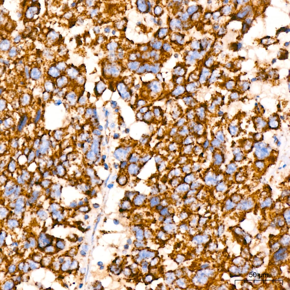Immunohistochemistry: PBR Antibody (4I9K6) [PBR] - Immunohistochemistry analysis of paraffin-embedded Human lung cancer tissue using PBR Rabbit mAb  at a dilution of 1:200 (40x lens). High pressure antigen retrieval performed with 0.01M Citrate Buffer (pH 6.0) prior to IHC staining.