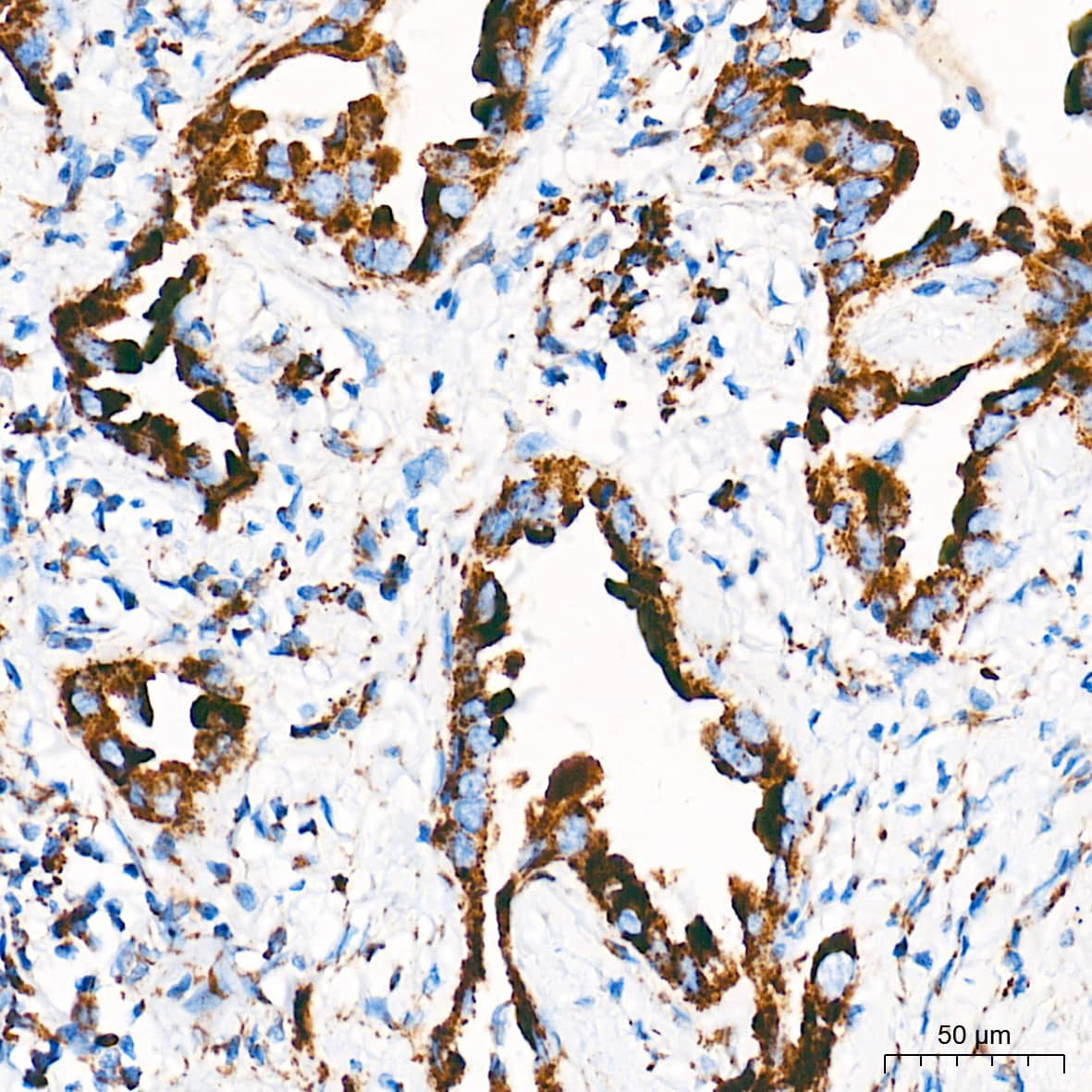 Immunohistochemistry: Cytochrome c Antibody (6R10F3) [NBP3-16512] - Immunohistochemistry analysis of paraffin-embedded Human lung cancer tissue using Cytochrome c Rabbit mAb at a dilution of 1:500 (40x lens). High pressure antigen retrieval performed with 0.01M Tris-EDTA Buffer (pH 9.0) prior to IHC staining.