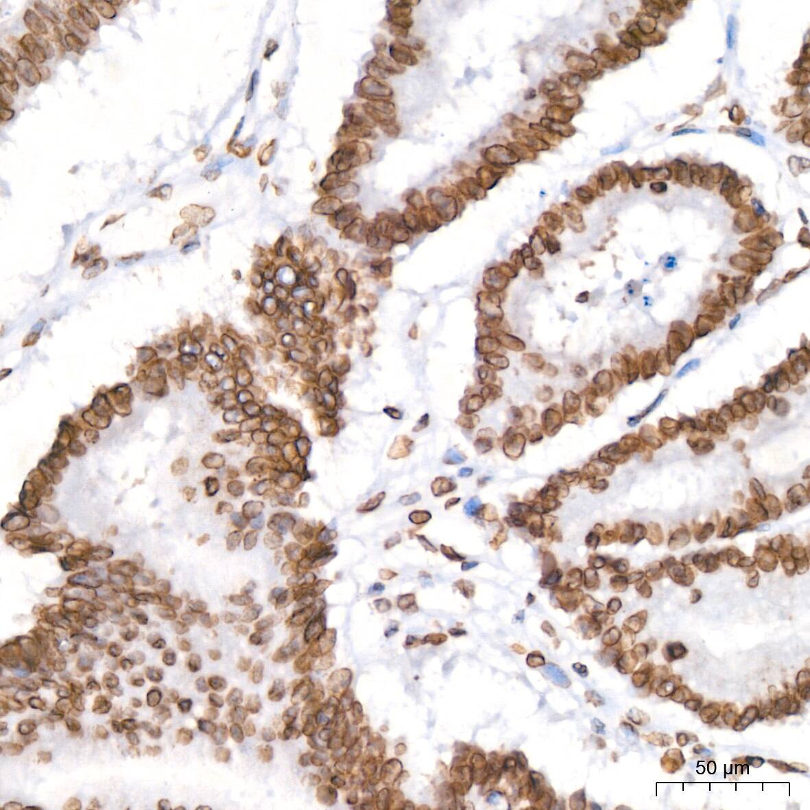 Immunohistochemistry: Lamin B2 Antibody (1S9M6) [Lamin B2] - Immunohistochemistry analysis of paraffin-embedded Human colon carcinoma tissue using Lamin B2 Rabbit mAb  at a dilution of 1:200 (40x lens). High pressure antigen retrieval was performed with 0.01 M citrate buffer (pH 6.0) prior to IHC staining.