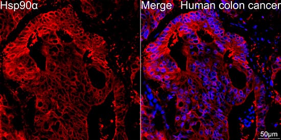 Immunocytochemistry/ Immunofluorescence: HSP90 alpha Antibody (0R3S6) [NBP3-16528] - Confocal imaging of paraffin-embedded Human colon cancer tissue using HSP90 alpha Rabbit mAb followed by a further incubation with Cy3 Goat Anti-Rabbit IgG (H+L) . DAPI was used for nuclear staining (Blue). High pressure antigen retrieval performed with 0.01M Citrate Buffer (pH 6.0) prior to IF staining. Objective: 40x.