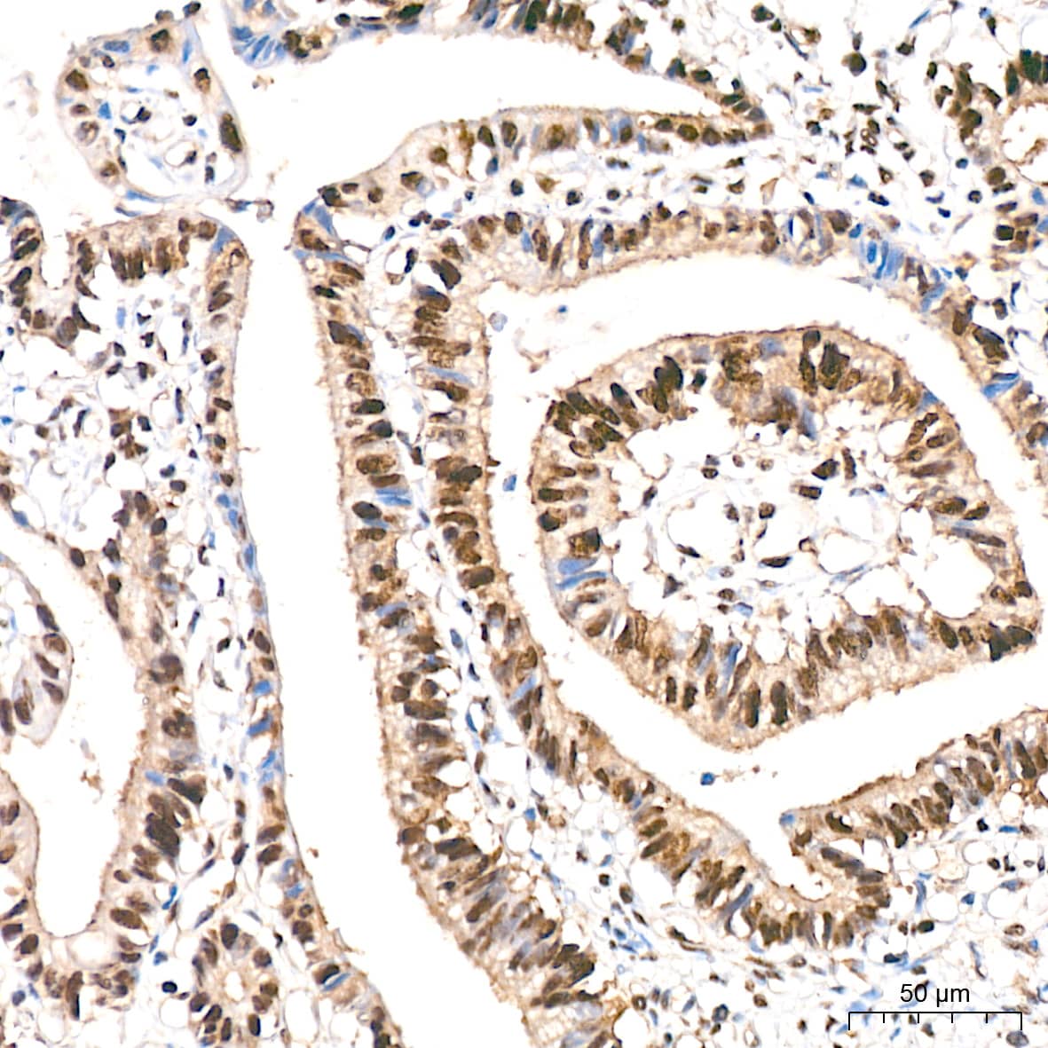 Immunohistochemistry: DDB1 Antibody (9L8X5) [NBP3-16531] - Immunohistochemistry analysis of paraffin-embedded Human colon carcinoma tissue using DDB1 Rabbit mAb at a dilution of 1:800 (40x lens). High pressure antigen retrieval performed with 0.01M Tris-EDTA Buffer (pH 9.0) prior to IHC staining.