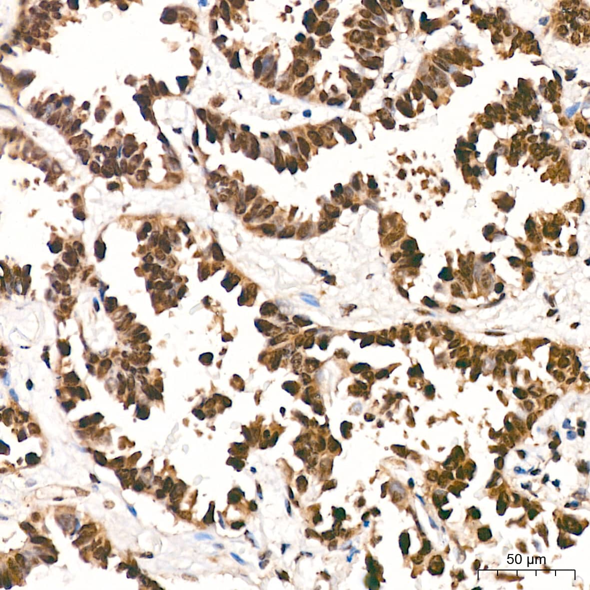 Immunohistochemistry: DDB1 Antibody (9L8X5) [NBP3-16531] - Immunohistochemistry analysis of paraffin-embedded Human lung adenocarcinoma tissue using DDB1 Rabbit mAb at a dilution of 1:800 (40x lens). High pressure antigen retrieval performed with 0.01M Tris-EDTA Buffer (pH 9.0) prior to IHC staining.