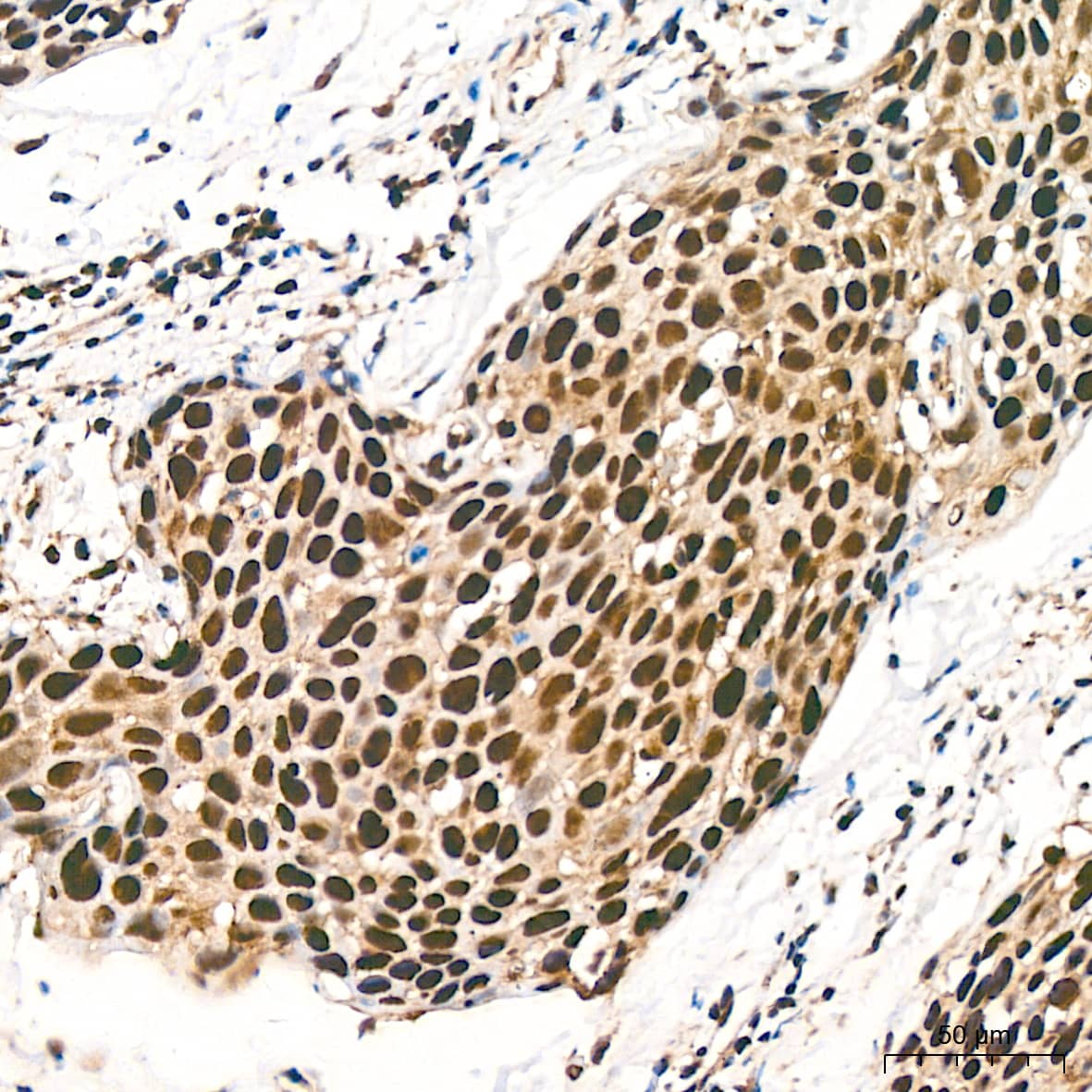 Immunohistochemistry: DDB1 Antibody (9L8X5) [NBP3-16531] - Immunohistochemistry analysis of paraffin-embedded Human cervix cancer tissue using DDB1 Rabbit mAb at a dilution of 1:800 (40x lens). High pressure antigen retrieval performed with 0.01M Tris-EDTA Buffer (pH 9.0) prior to IHC staining.