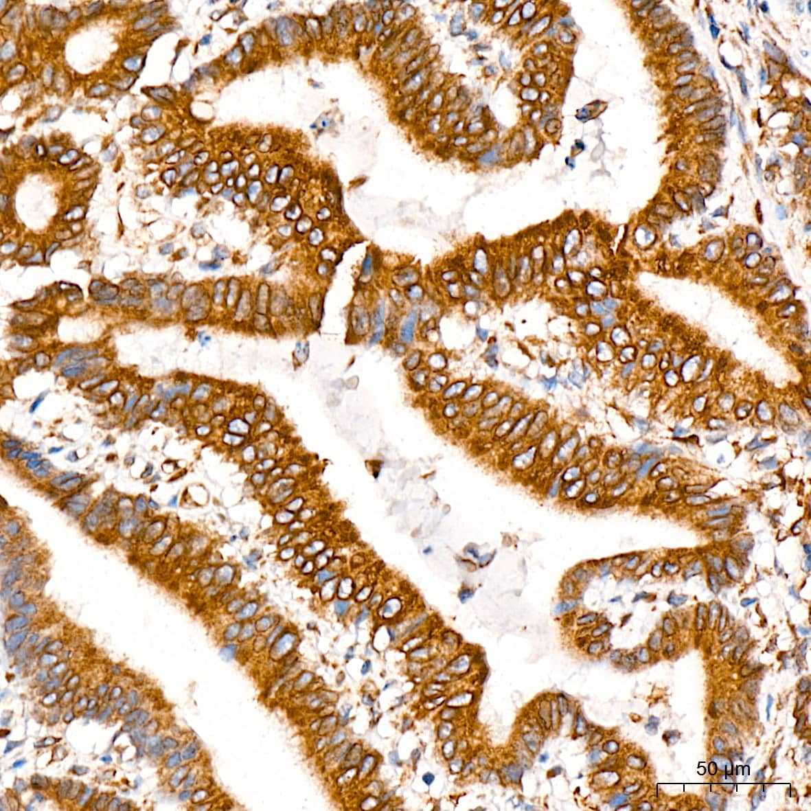 Immunohistochemistry: POR/Cytochrome P450 Reductase Antibody (9U1U7) [NBP3-16534] - Immunohistochemistry analysis of POR/Cytochrome P450 Reductase in paraffin-embedded human colon carcinoma tissue using POR/Cytochrome P450 Reductase Rabbit mAb  at a dilution of 1:200 (40x lens). High pressure antigen retrieval was performed with 0.01 M citrate buffer (pH 6.0) prior to IHC staining.