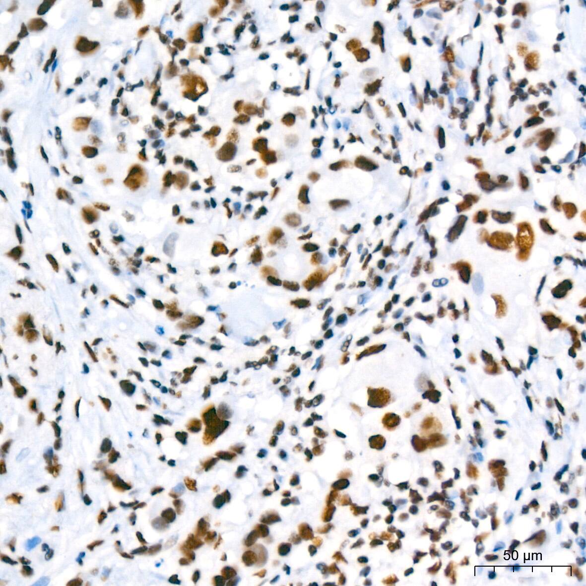 Immunohistochemistry: SUMO2/3 Antibody (6R8G7) [NBP3-16540] - Immunohistochemistry analysis of paraffin-embedded Human breast cancer using SUMO2/3 Rabbit mAb at dilution of 1:200 (40x lens). High pressure antigen retrieval performed with 0.01M Tris/EDTA Buffer (pH 9.0) prior to IHC staining.