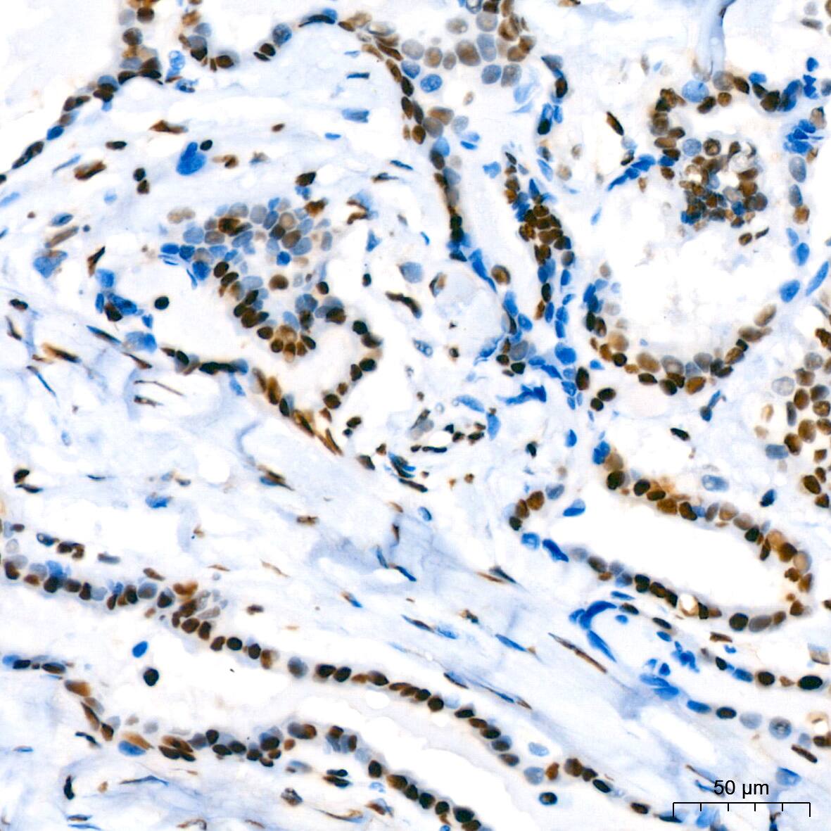 Immunohistochemistry: SUMO2/3 Antibody (6R8G7) [SUMO2/3] - Immunohistochemistry analysis of paraffin-embedded Human thyroid cancer using SUMO2/3 Rabbit mAb  at dilution of 1:200 (40x lens). High pressure antigen retrieval performed with 0.01M Tris/EDTA Buffer (pH 9.0) prior to IHC staining.