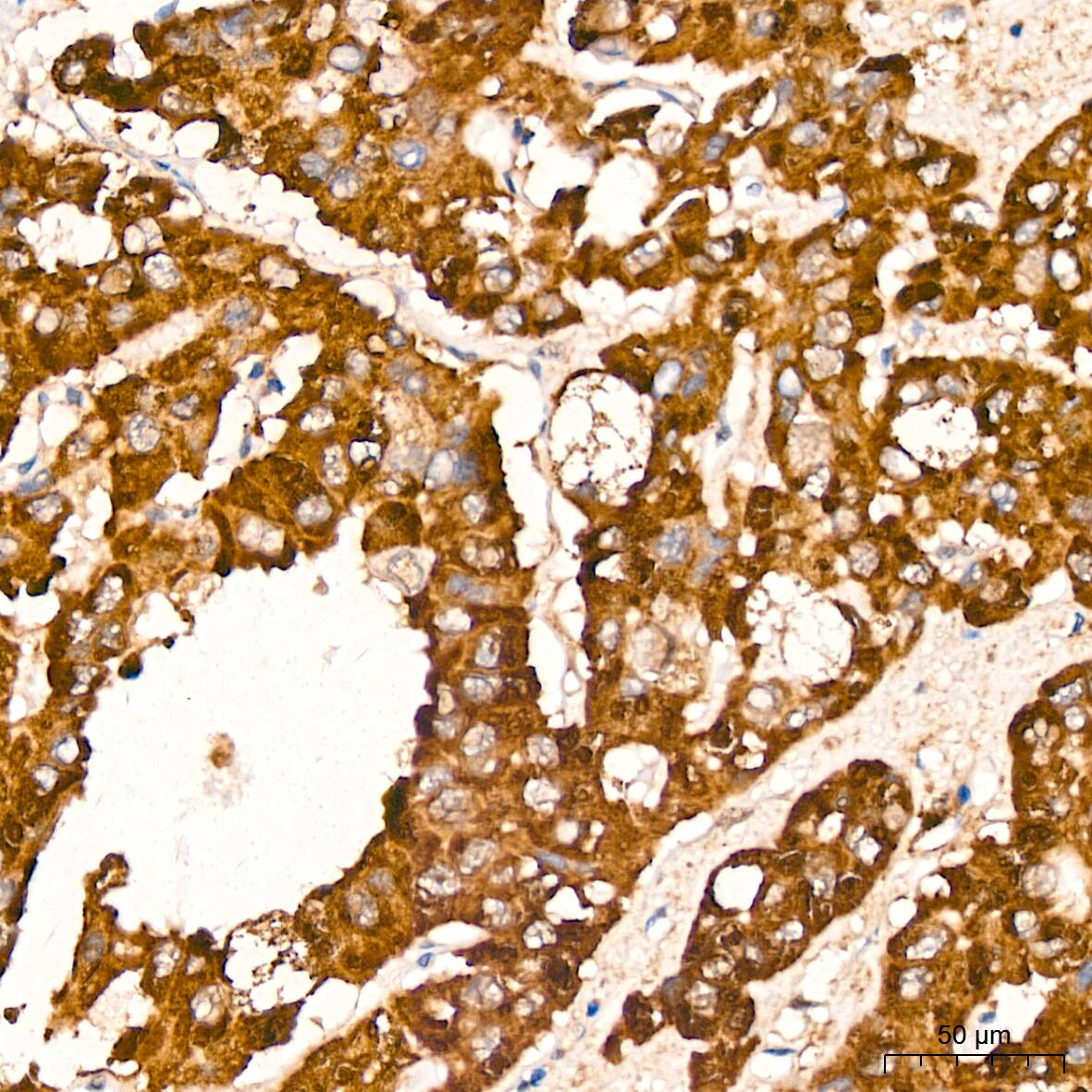 Immunohistochemistry: Proteasome 20S alpha 3 Antibody (7X8W9) [NBP3-16551] - Immunohistochemistry analysis of Proteasome 20S alpha 3 in paraffin-embedded human liver cancer tissue using Proteasome 20S alpha 3 Rabbit mAb  at a dilution of 1:1000 (40x lens). High pressure antigen retrieval was performed with 0.01 M citrate buffer (pH 6.0) prior to IHC staining.