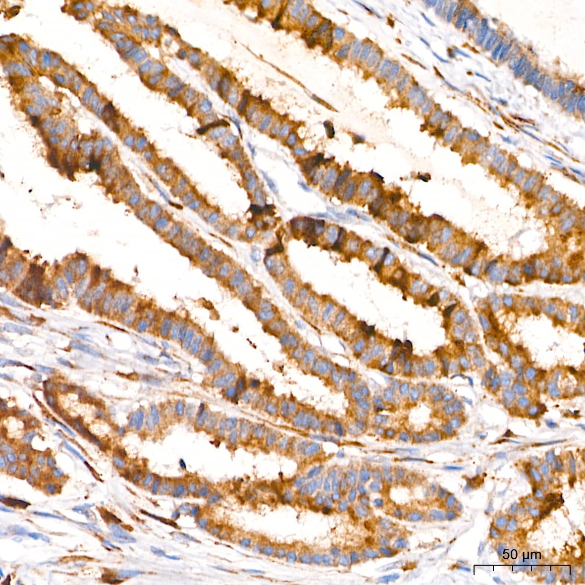 Immunohistochemistry: PAR2 Antibody (9X8E6) [NBP3-16555] - Immunohistochemistry analysis of paraffin-embedded Human colon carcinoma tissue using PAR2 Rabbit mAb at a dilution of 1:500 (40x lens). High pressure antigen retrieval performed with 0.01M Tris-EDTA Buffer (pH 9.0) prior to IHC staining.