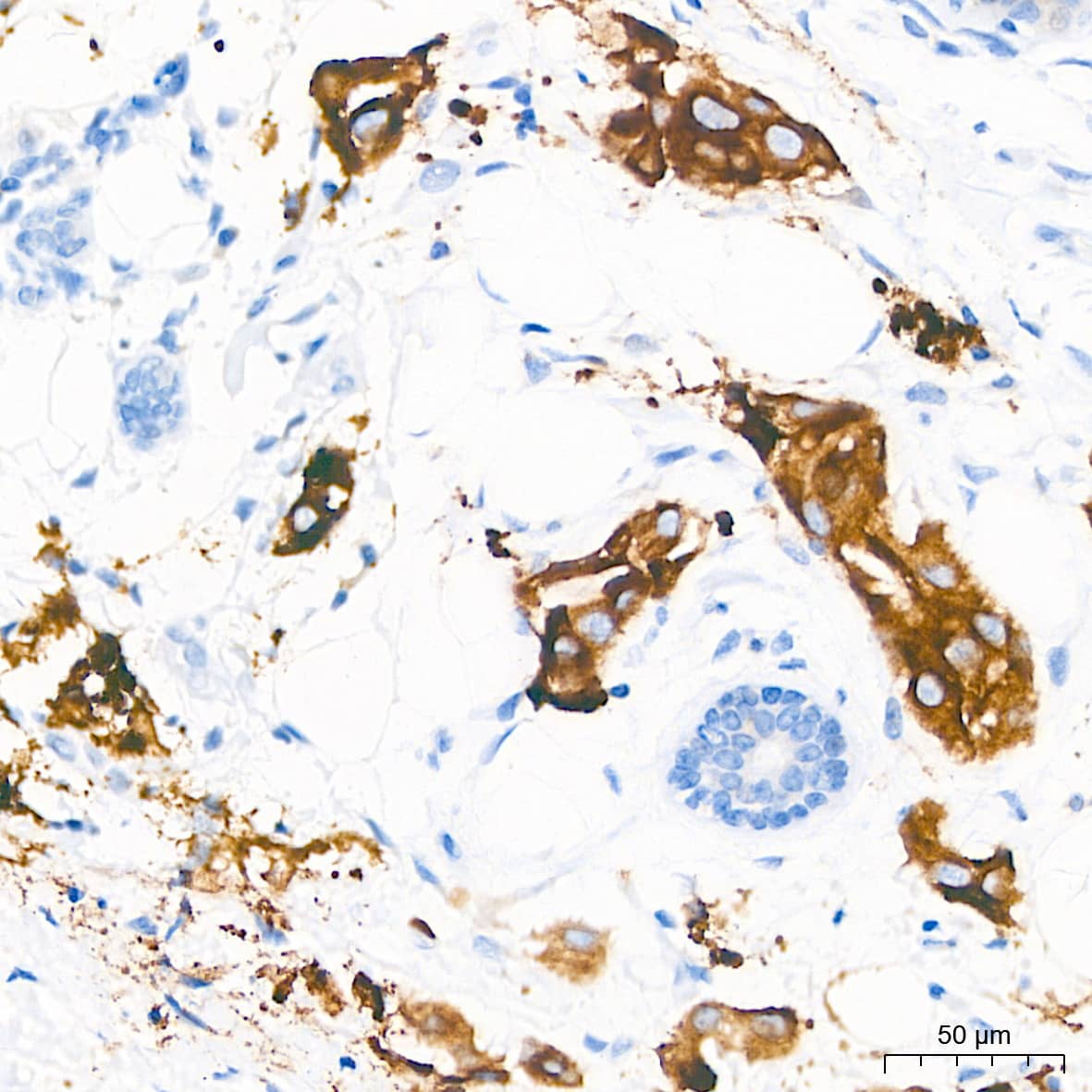 Immunohistochemistry: PAR2 Antibody (9X8E6) [NBP3-16555] - Immunohistochemistry analysis of paraffin-embedded Human breast cancer tissue using PAR2 Rabbit mAb at a dilution of 1:500 (40x lens). High pressure antigen retrieval performed with 0.01M Tris-EDTA Buffer (pH 9.0) prior to IHC staining.