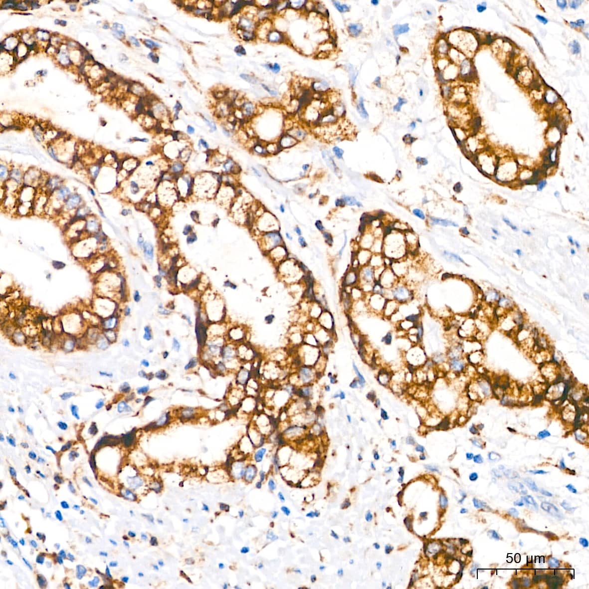 Immunohistochemistry: PAR2 Antibody (9X8E6) [PAR2] - Immunohistochemistry analysis of paraffin-embedded Human gastric cancer tissue using PAR2 Rabbit mAb  at a dilution of 1:500 (40x lens). High pressure antigen retrieval performed with 0.01M Tris-EDTA Buffer (pH 9.0) prior to IHC staining.