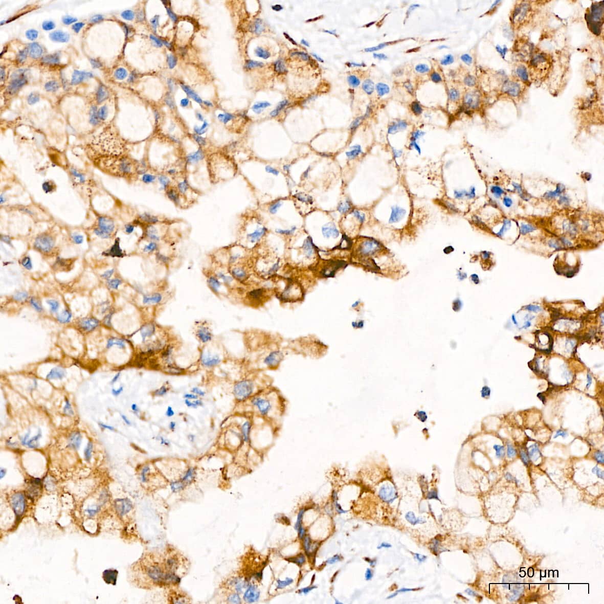 Immunohistochemistry: PAR2 Antibody (9X8E6) [PAR2] - Immunohistochemistry analysis of paraffin-embedded Human pancreatic cancer tissue using PAR2 Rabbit mAb  at a dilution of 1:500 (40x lens). High pressure antigen retrieval performed with 0.01M Tris-EDTA Buffer (pH 9.0) prior to IHC staining.