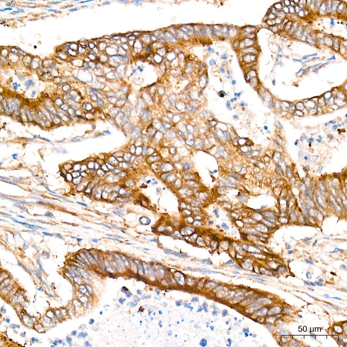 Immunohistochemistry: PA2G4/EBP1 Antibody (9J9U5) [NBP3-16561] - Immunohistochemistry analysis of PA2G4/EBP1 in paraffin-embedded human colon carcinoma tissue using PA2G4/EBP1 Rabbit mAb  at a dilution of 1:800 (40x lens). High pressure antigen retrieval was performed with 0.01 M citrate buffer (pH 6.0) prior to IHC staining.