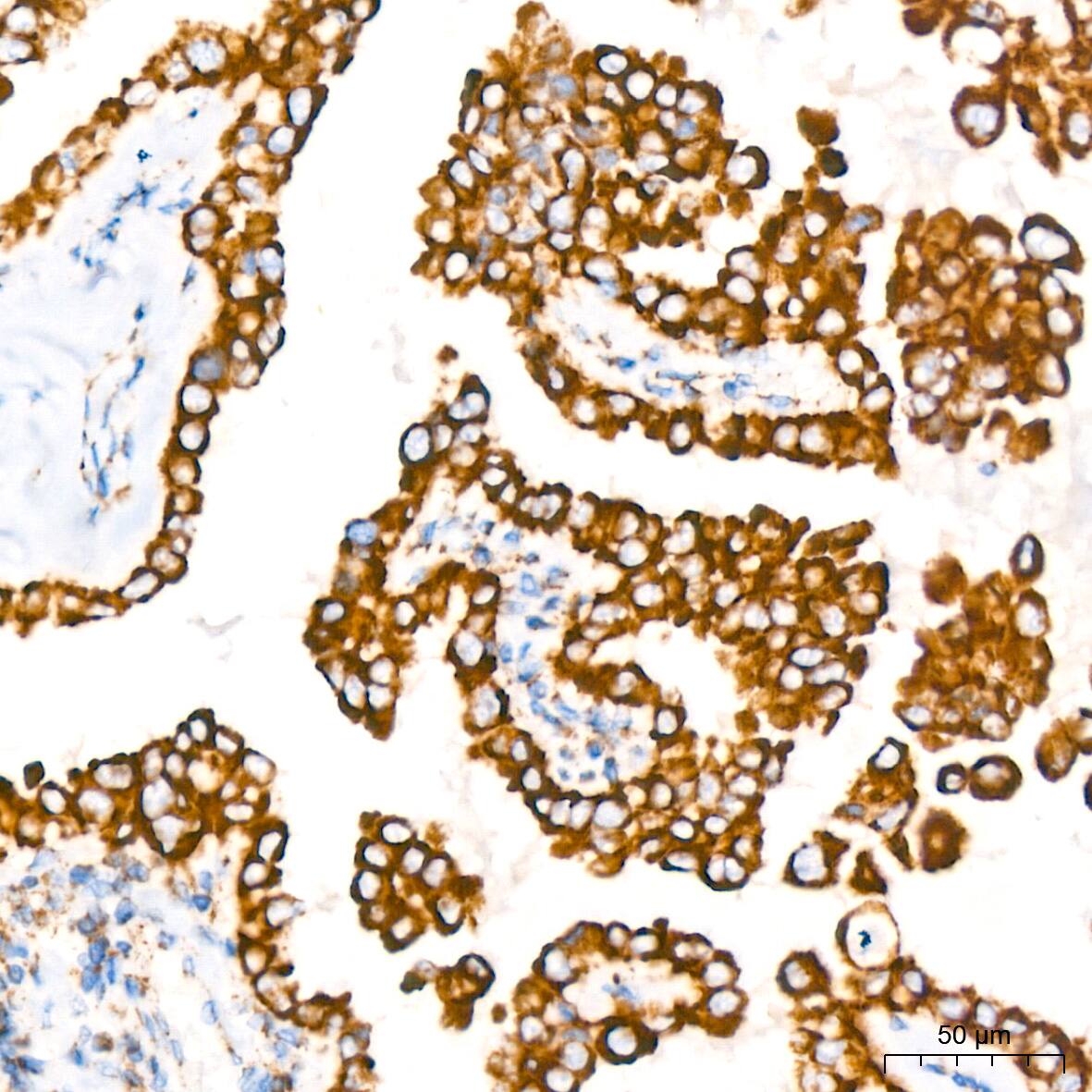 Immunohistochemistry: Glutamate Dehydrogenase Antibody (7L7N2) [NBP3-16582] - Immunohistochemistry analysis of paraffin-embedded Human thyroid cancer tissue using Glutamate Dehydrogenase Rabbit mAb at a dilution of 1:200 (40x lens). High pressure antigen retrieval performed with 0.01M Tris-EDTA Buffer (pH 9.0) prior to IHC staining.