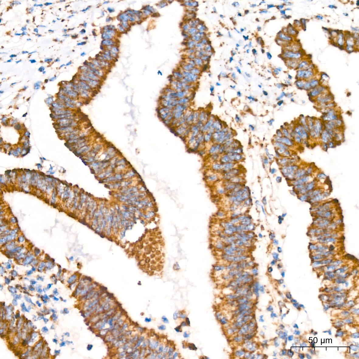 Immunohistochemistry: Glutamate Dehydrogenase Antibody (7L7N2) [NBP3-16582] - Immunohistochemistry analysis of paraffin-embedded Human colon carcinoma tissue using Glutamate Dehydrogenase Rabbit mAb at a dilution of 1:200 (40x lens). High pressure antigen retrieval performed with 0.01M Tris-EDTA Buffer (pH 9.0) prior to IHC staining.