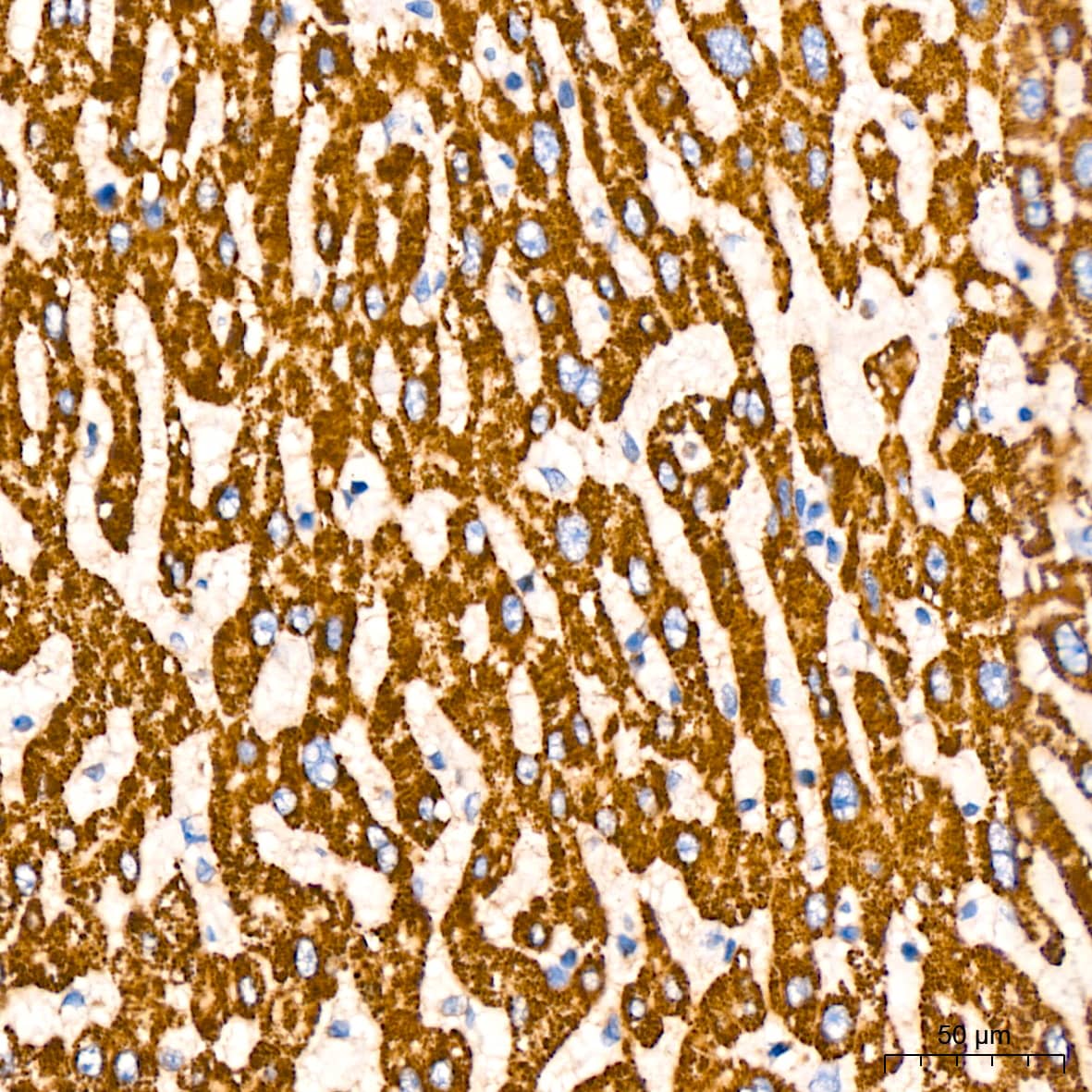 Immunohistochemistry: Glutamate Dehydrogenase Antibody (7L7N2) [NBP3-16582] - Immunohistochemistry analysis of paraffin-embedded Human liver cancer tissue using Glutamate Dehydrogenase Rabbit mAb at a dilution of 1:200 (40x lens). High pressure antigen retrieval performed with 0.01M Tris-EDTA Buffer (pH 9.0) prior to IHC staining.