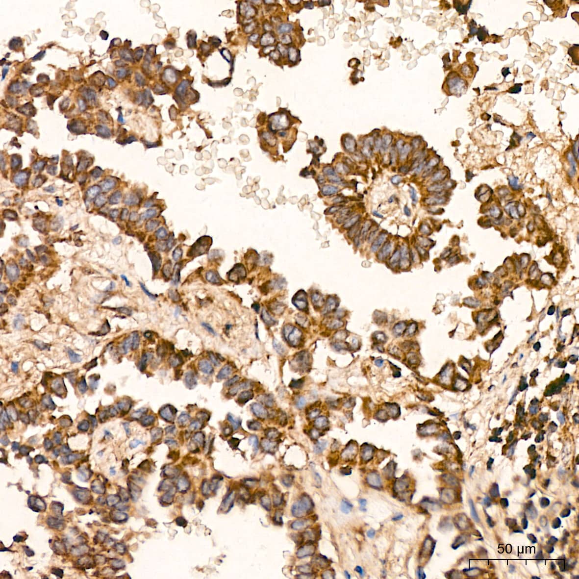 Immunohistochemistry: HSP10/EPF Antibody (0H0X6) [NBP3-16604] - Immunohistochemistry analysis of paraffin-embedded Human thyroid cancer tissue using HSP10/EPF Rabbit mAb at a dilution of 1:400 (40x lens). High pressure antigen retrieval was performed with 0.01 M citrate buffer (pH 6.0) prior to IHC staining.