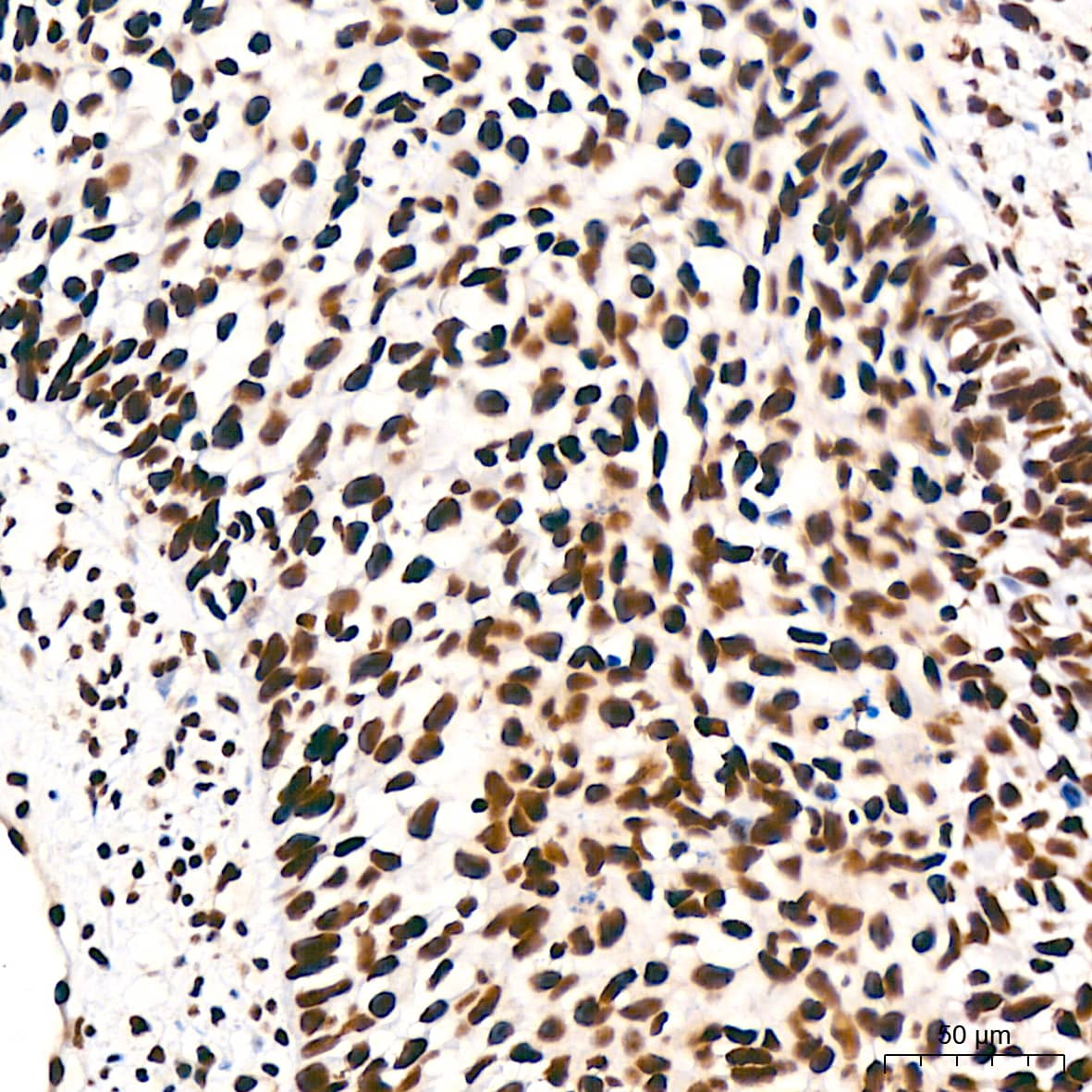 Immunohistochemistry: DDX17 Antibody (2U1P0) [NBP3-16607] - Immunohistochemistry analysis of DDX17 in paraffin-embedded human cervix cancer tissue using DDX17 Rabbit mAb  at a dilution of 1:200 (40x lens).High pressure antigen retrieval was performed with 0.01 M Tris-EDTA buffer (pH 9.0) prior to IHC staining.