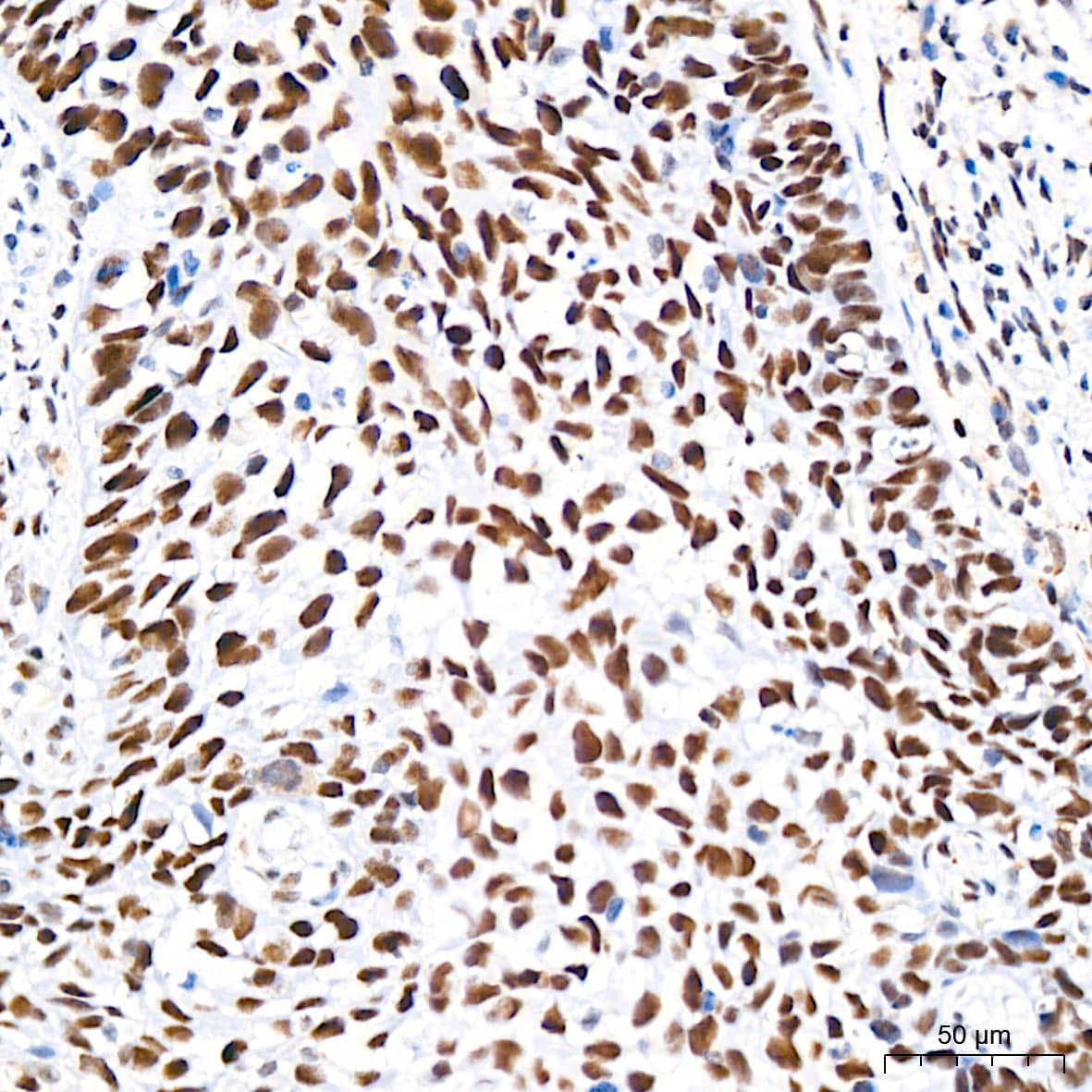 Immunohistochemistry: CHD3 Antibody (8Z6L6) [NBP3-16632] - Immunohistochemistry analysis of CHD3 in paraffin-embedded human cervix cancer tissue using CHD3 Rabbit mAb at a dilution of 1:200 (40x lens).High pressure antigen retrieval was performed with 0.01 M citrate buffer (pH 6.0) prior to IHC staining.