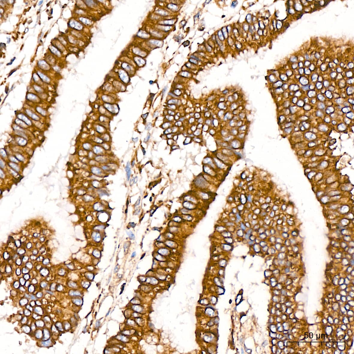 Immunohistochemistry: ADAM15 Antibody (4T4X10) [NBP3-16642] - Immunohistochemistry analysis of paraffin-embedded Human colon carcinoma tissue using ADAM15 Rabbit mAb at a dilution of 1:200 (40x lens). High pressure antigen retrieval performed with 0.01M Citrate Bufferr (pH 6.0) prior to IHC staining.