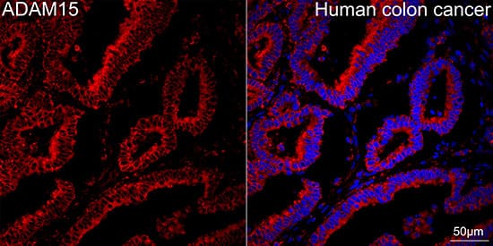 Immunocytochemistry/ Immunofluorescence: ADAM15 Antibody (4T4X10) [NBP3-16642] - Confocal imaging of paraffin-embedded Human colon cancer using ADAM15 Rabbit mAb followed by a further incubation with Cy3 Goat Anti-Rabbit IgG (H+L).DAPI was used for nuclear staining (Blue). Objective: 40x.Perform high pressure antigen retrieval with 0.01M citrate buffer (pH 6.0) prior to IF staining.