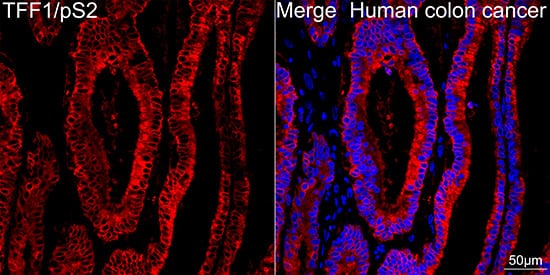 Immunocytochemistry/ Immunofluorescence: TFF1/pS2 Antibody (6P6R7) [NBP3-16651] - Confocal imaging of paraffin-embedded Human colon cancer tissue using TFF1/pS2 Rabbit mAb followed by a further incubation with Cy3 Goat Anti-Rabbit IgG (H+L) . DAPI was used for nuclear staining (Blue). Objective: 40x. Perform high pressure antigen retrieval with 0.01 M citrate buffer (pH 6.0) prior to IF staining.