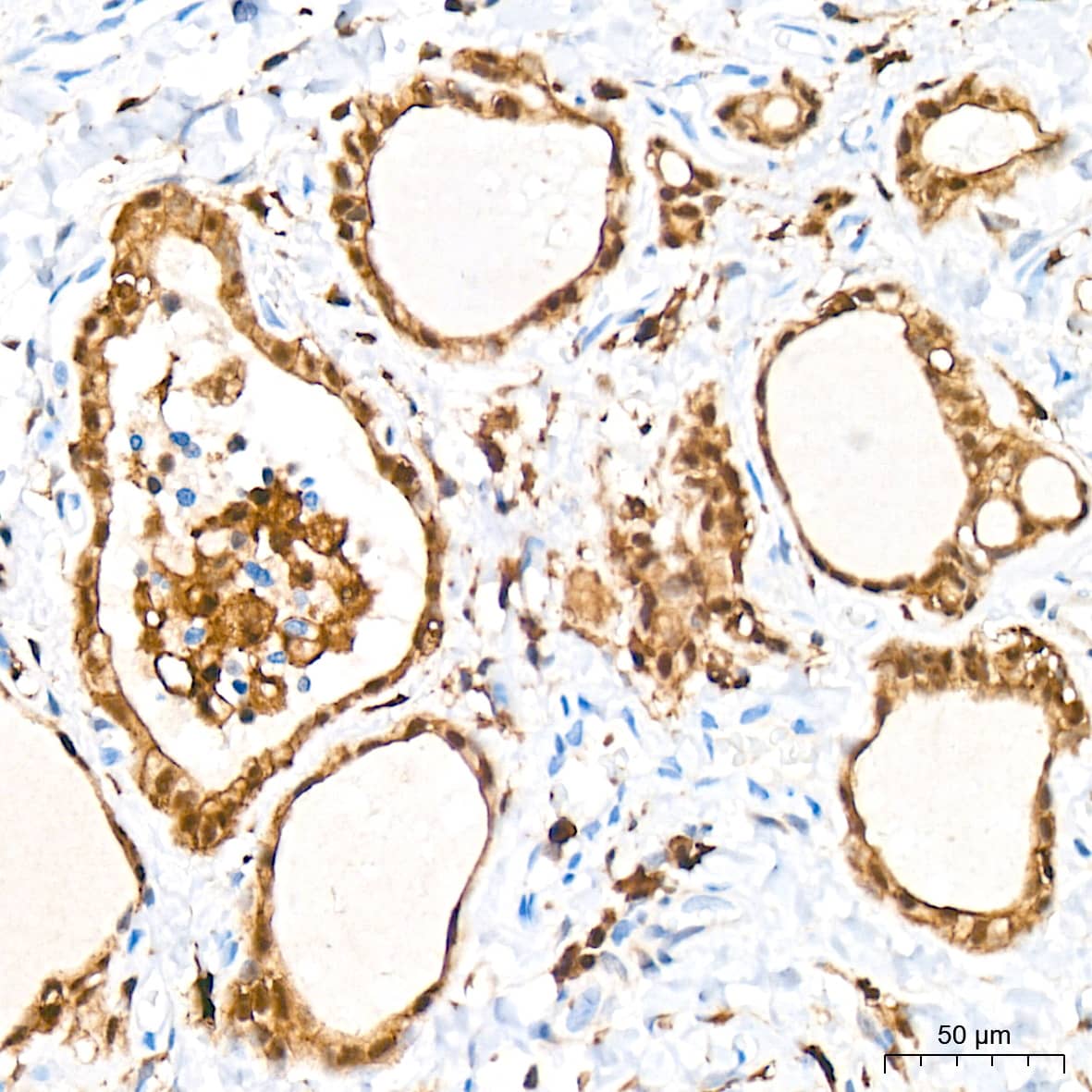 Immunohistochemistry: PKC delta Antibody (7I5U6) [NBP3-16660] - Immunohistochemistry analysis of PKC delta in paraffin-embedded human thyroid tissue using PKC delta Rabbit mAb  at a dilution of 1:200 (40x lens). High pressure antigen retrieval was performed with 0.01 M citrate buffer (pH 6.0) prior to IHC staining.