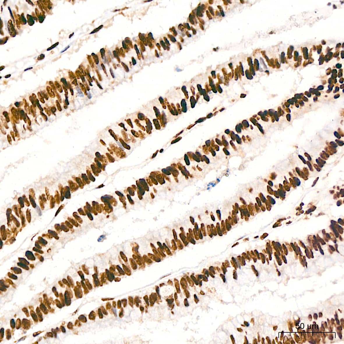 Immunohistochemistry: ILF3 Antibody (0S2N7) [NBP3-16664] - Immunohistochemistry analysis of ILF3 in paraffin-embedded human colon carcinoma tissue using ILF3 Rabbit mAb  at a dilution of 1:200 (40x lens). High pressure antigen retrieval was performed with 0.01 M citrate buffer (pH 6.0) prior to IHC staining.