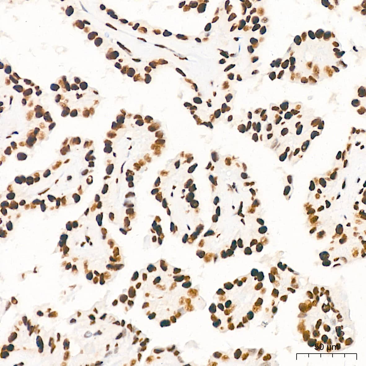 Immunohistochemistry: ILF3 Antibody (0S2N7) [NBP3-16664] - Immunohistochemistry analysis of ILF3 in paraffin-embedded human thyroid cancer tissue using ILF3 Rabbit mAb  at a dilution of 1:200 (40x lens). High pressure antigen retrieval was performed with 0.01 M citrate buffer (pH 6.0) prior to IHC staining.