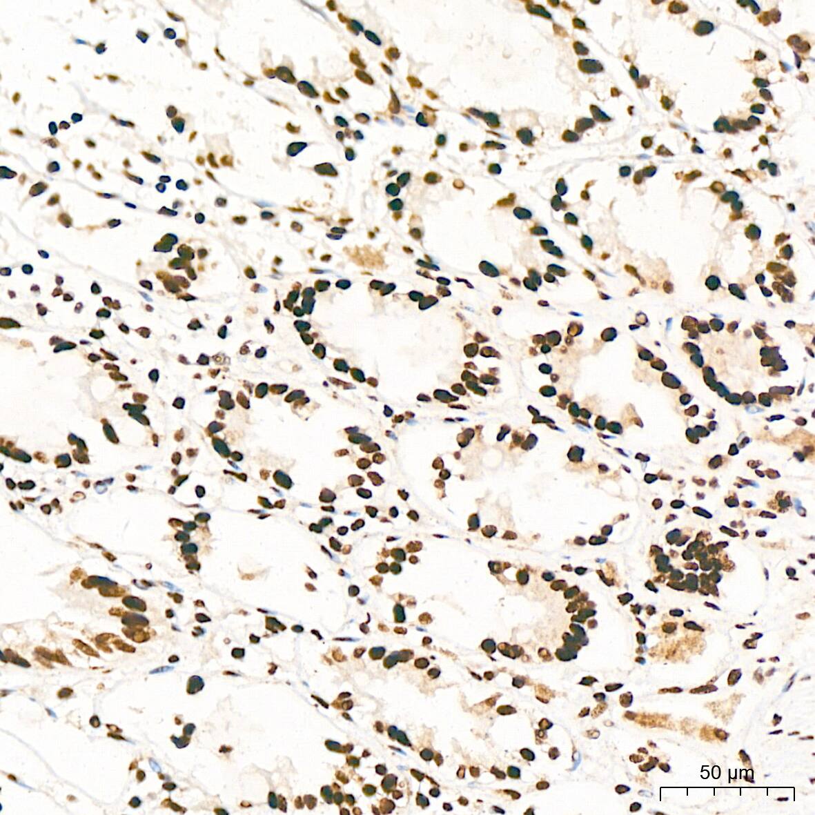 Immunohistochemistry: ILF3 Antibody (0S2N7) [NBP3-16664] - Immunohistochemistry analysis of ILF3 in paraffin-embedded human colon tissue using ILF3 Rabbit mAb  at a dilution of 1:200 (40x lens). High pressure antigen retrieval was performed with 0.01 M citrate buffer (pH 6.0) prior to IHC staining.