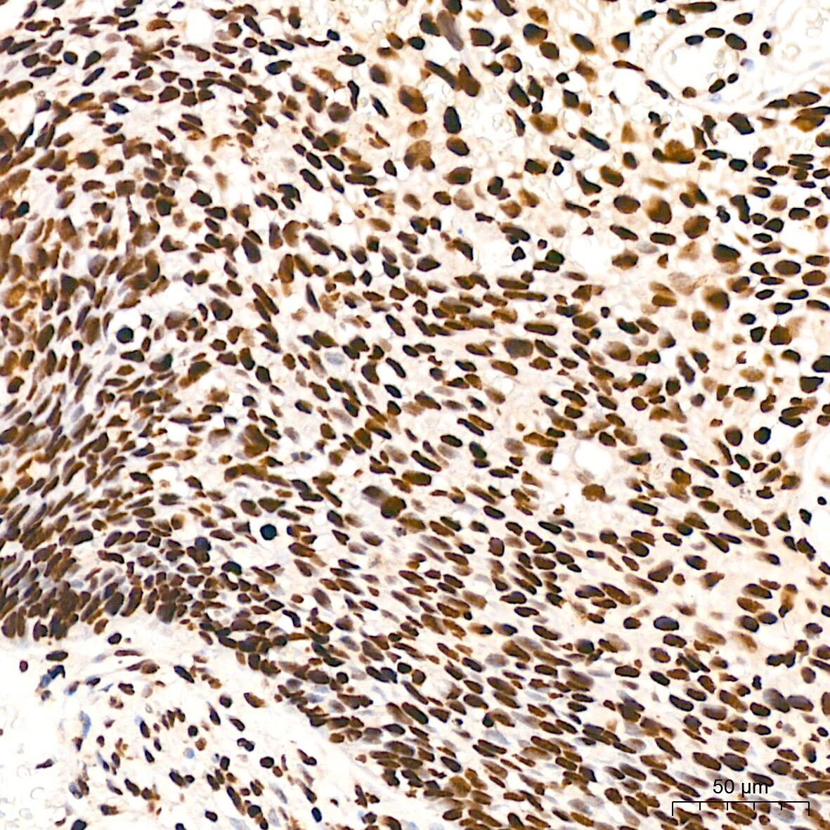 Immunohistochemistry: ILF3 Antibody (0S2N7) [NBP3-16664] - Immunohistochemistry analysis of ILF3 in paraffin-embedded human cervix cancer tissue using ILF3 Rabbit mAb  at a dilution of 1:200 (40x lens). High pressure antigen retrieval was performed with 0.01 M citrate buffer (pH 6.0) prior to IHC staining.