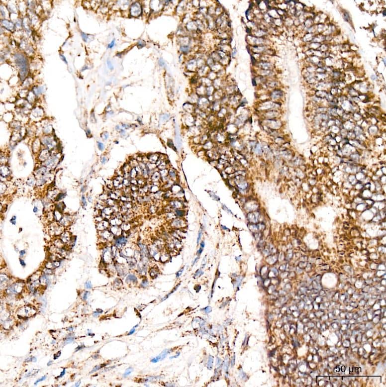 Immunohistochemistry-Paraffin: Ndufs4 Antibody (6T10F4) [NBP3-16679] - Analysis of NDUFS4 in paraffin-embedded human colon carcinoma tissue using NDUFS4 Rabbit mAb at a dilution of 1:400 (40x lens). High pressure antigen retrieval was performed with 0.01 M citrate buffer (pH 6.0) prior to IHC staining.