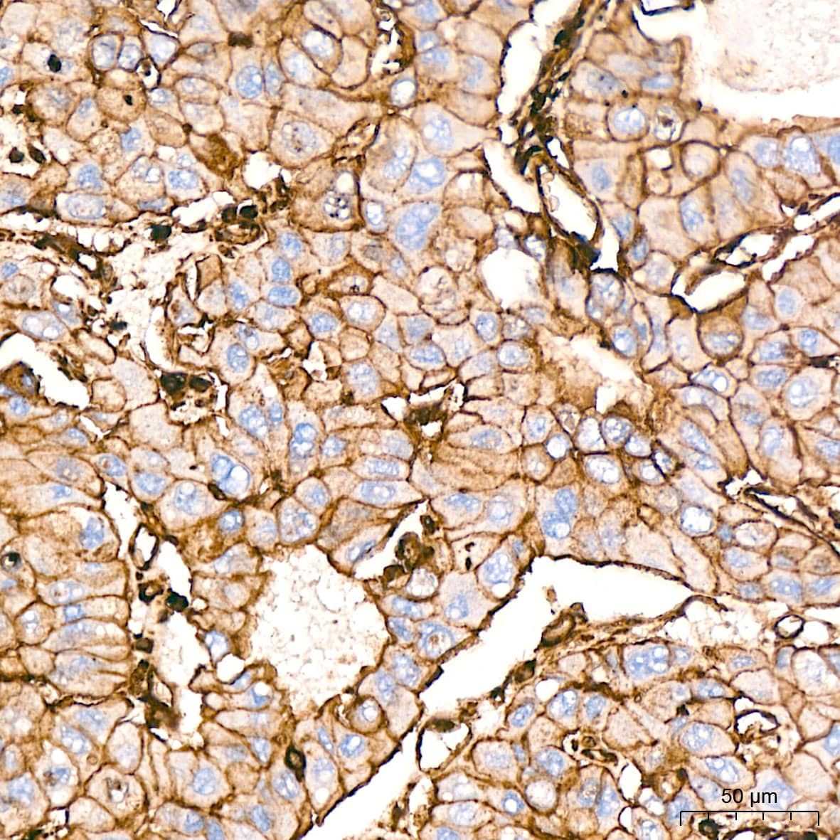 Immunohistochemistry: Somatostatin R5/SSTR5 Antibody (4O6N5) [NBP3-16682] - Immunohistochemistry analysis of Somatostatin R5/SSTR5 in paraffin-embedded human liver cancer tissue using Somatostatin R5/SSTR5 Rabbit mAb  at a dilution of 1:800 (40x lens). High pressure antigen retrieval was performed with 0.01 M citrate buffer (pH 6.0) prior to IHC staining.