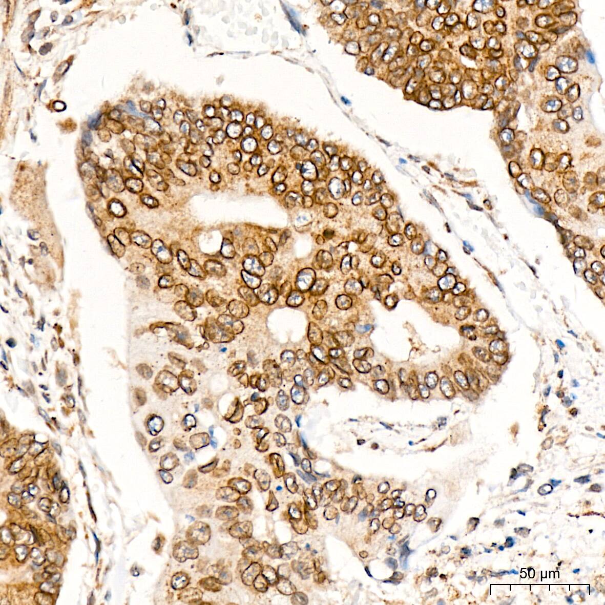 Immunohistochemistry: RanGAP1 Antibody (1E7R7) [NBP3-16697] - Immunohistochemistry analysis of RanGAP1 in paraffin-embedded human colon carcinoma tissue using RanGAP1 Rabbit mAb  at a dilution of 1:200 (40x lens). High pressure antigen retrieval was performed with 0.01 M citrate buffer (pH 6.0) prior to IHC staining.