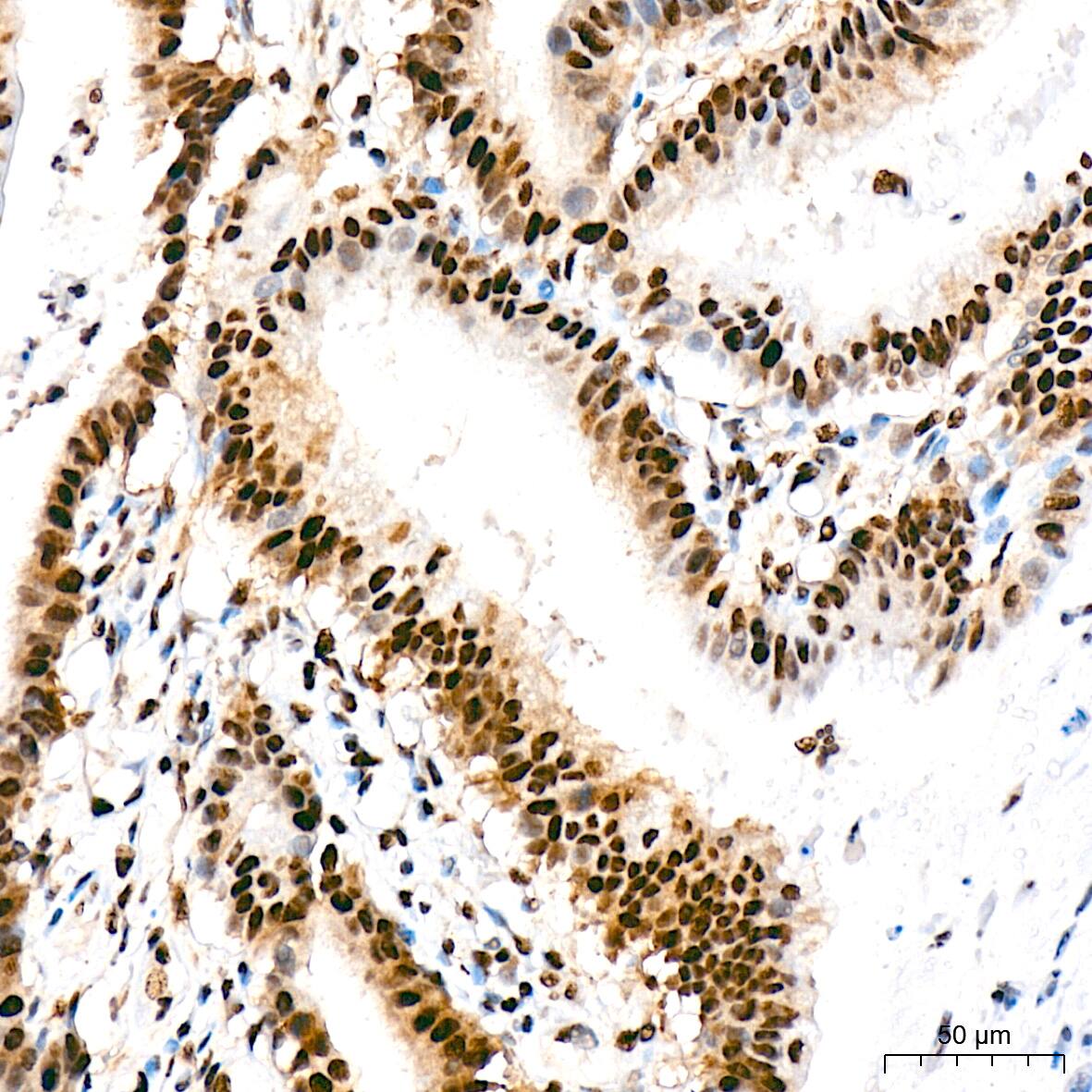 Immunohistochemistry: Bub3 Antibody (10G1S6) [NBP3-16709] - Immunohistochemistry analysis of Bub3 in paraffin-embedded human colon carcinoma tissue using Bub3 Rabbit mAb  at a dilution of 1:200 (40x lens). High pressure antigen retrieval was performed with 0.01 M citrate buffer (pH 6.0) prior to IHC staining.