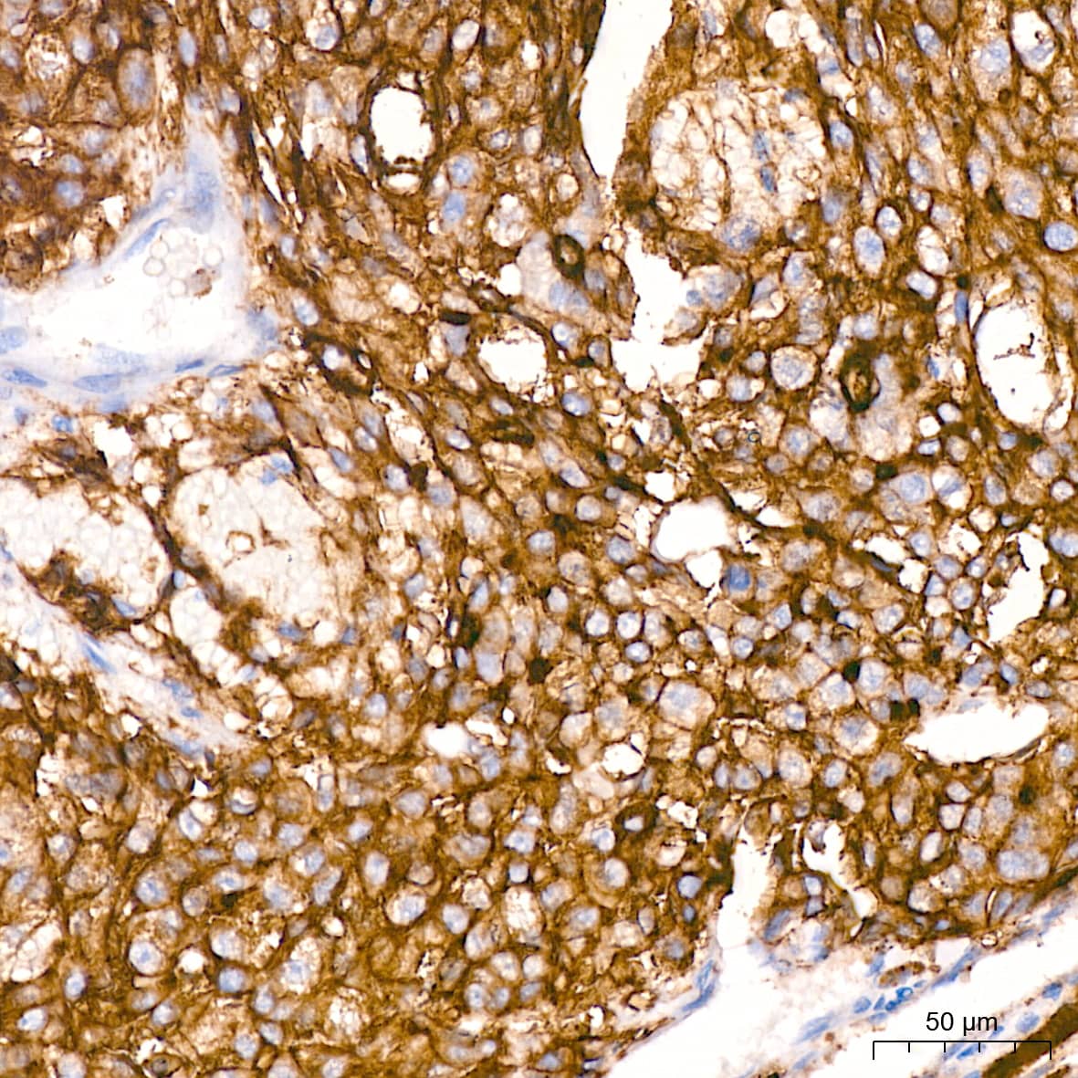 Immunohistochemistry: Xanthine Oxidase Antibody (0M8E7) [Xanthine Oxidase] - Immunohistochemistry analysis of paraffin-embedded Human liver cancer using Xanthine Oxidase Rabbit mAb  at dilution of 1:200 (40x lens). High pressure antigen retrieval performed with 0.01M Citrate Bufferr (pH 6.0) prior to IHC staining.