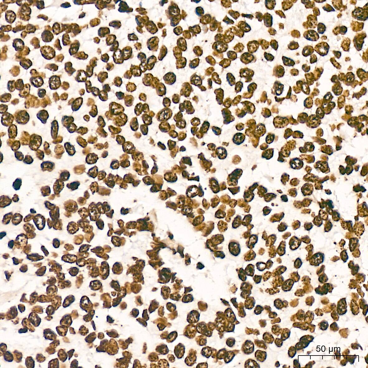 Immunohistochemistry: Histone H2AY/macroH2A.1 Antibody (4D2O4) [NBP3-16743] - Immunohistochemistry analysis of Histone H2AY/macroH2A.1 in paraffin-embedded human breast cancer tissue using Histone H2AY/macroH2A.1 Rabbit mAb  at a dilution of 1:200 (40x lens). High pressure antigen retrieval was performed with 0.01 M citrate buffer (pH 6.0) prior to IHC staining.