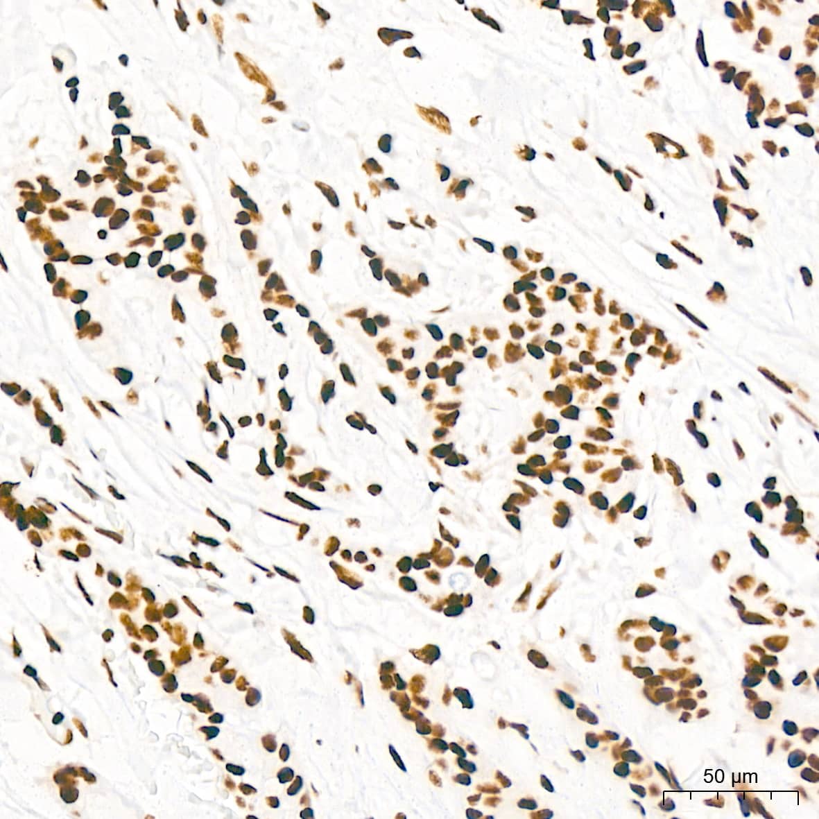 Immunohistochemistry: KHSRP Antibody (4V4O1) [NBP3-16746] - Immunohistochemistry analysis of KHSRP in paraffin-embedded human breast cancer tissue using KHSRP Rabbit mAb  at a dilution of 1:200 (40x lens).High pressure antigen retrieval was performed with 0.01 M citrate buffer (pH 6.0) prior to IHC staining.