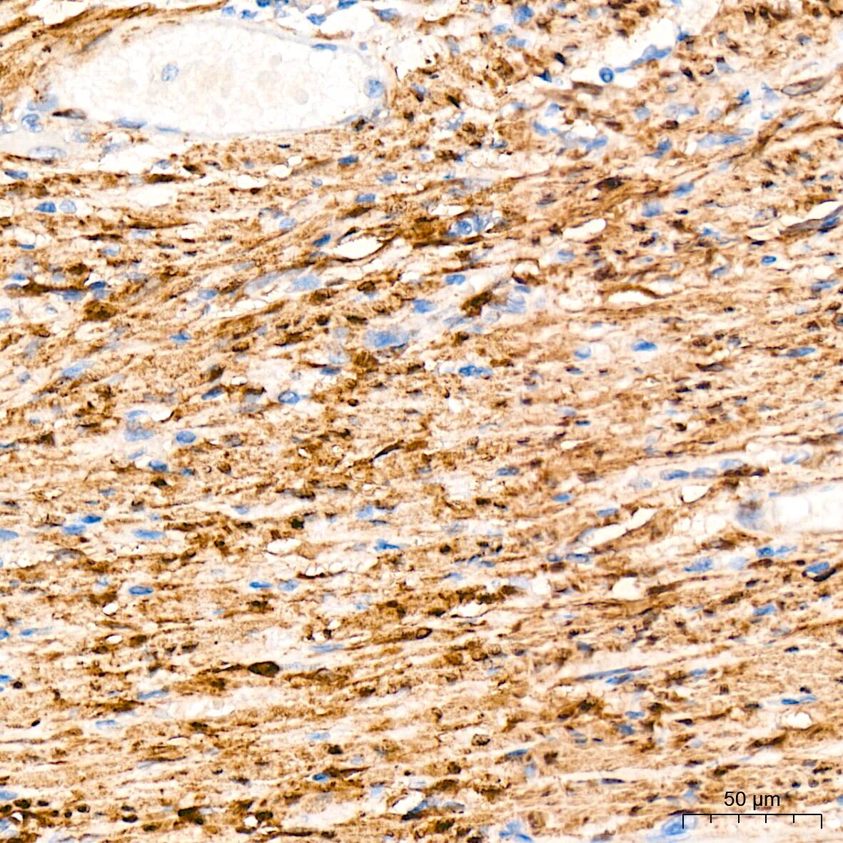 Immunohistochemistry: HSP20/HSPB6 Antibody (3J5N1) [NBP3-16751] - Immunohistochemistry analysis of HSP20/HSPB6 in paraffin-embedded human colon carcinoma tissue using HSP20/HSPB6 Rabbit mAb  at a dilution of 1:200 (40x lens). High pressure antigen retrieval was performed with 0.01 M Tris-EDTA buffer (pH 9.0) prior to IHC staining.