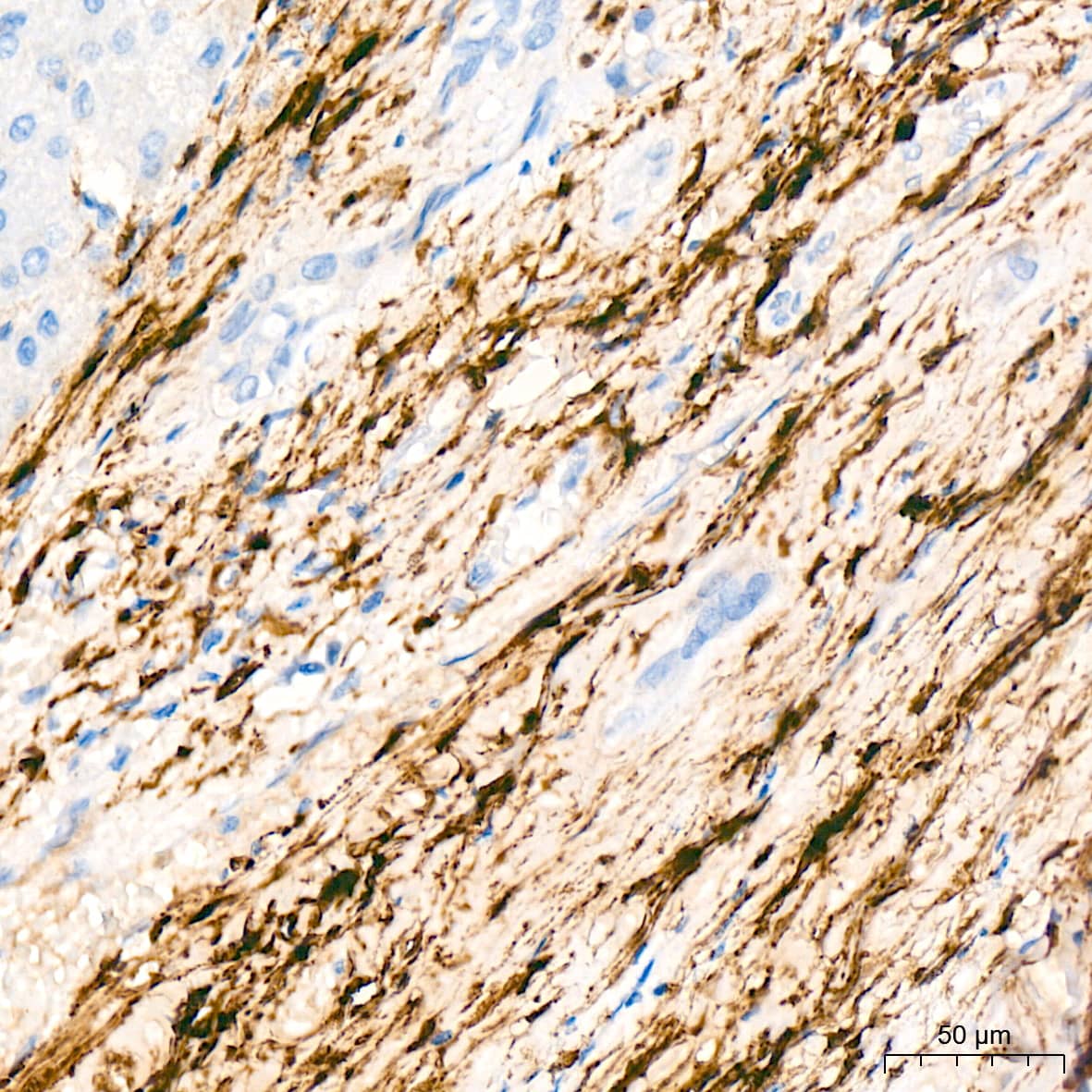 Immunohistochemistry: HSP20/HSPB6 Antibody (3J5N1) [NBP3-16751] - Immunohistochemistry analysis of HSP20/HSPB6 in paraffin-embedded human liver cancer tissue using HSP20/HSPB6 Rabbit mAb  at a dilution of 1:200 (40x lens). High pressure antigen retrieval was performed with 0.01 M Tris-EDTA buffer (pH 9.0) prior to IHC staining.