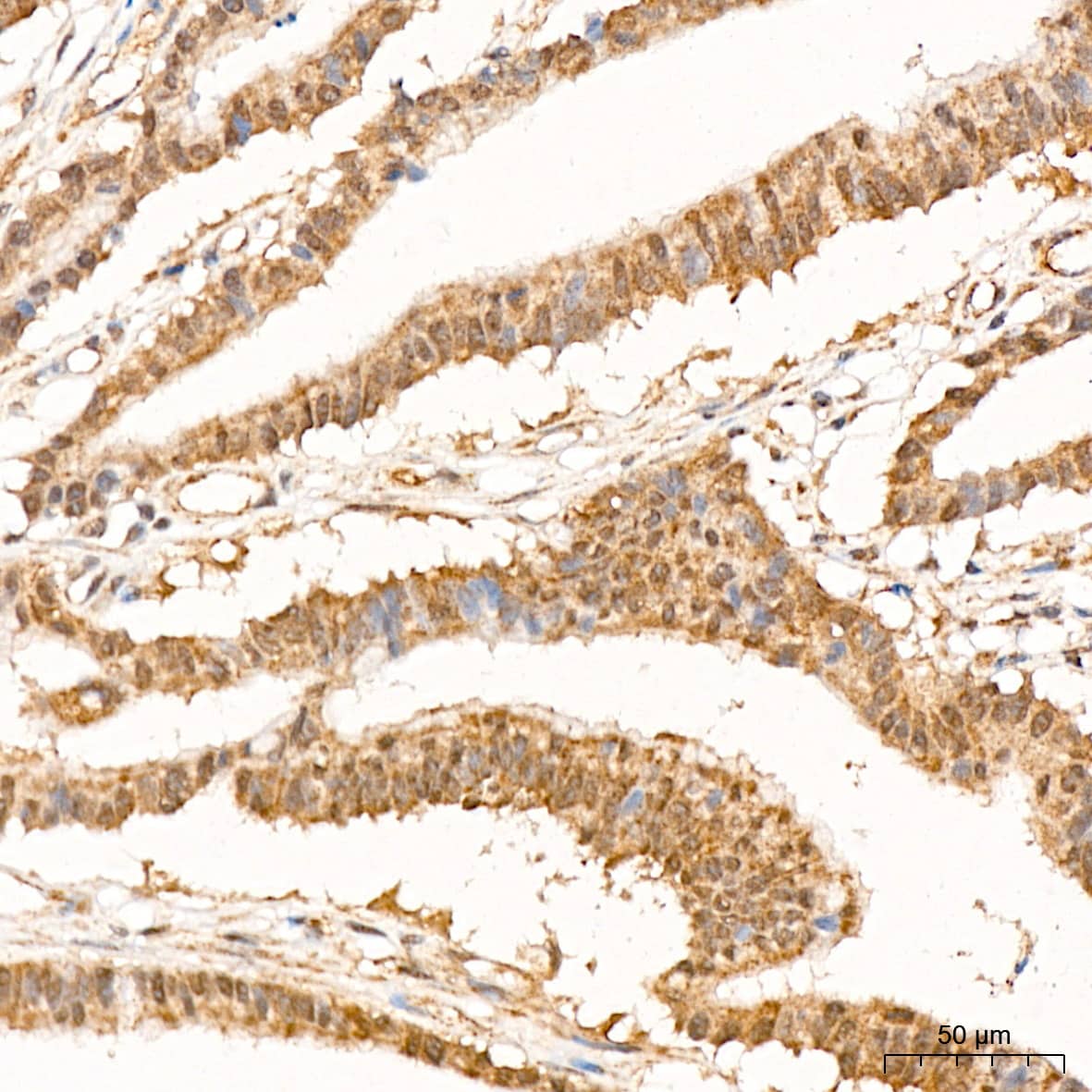 Immunohistochemistry: p70 S6 Kinase beta/S6K2 Antibody (5D8F5) [NBP3-16752] - Immunohistochemistry analysis of p70 S6 Kinase beta/S6K2 in paraffin-embedded human colon carcinoma tissue using p70 S6 Kinase beta/S6K2 Rabbit mAb  at a dilution of 1:200 (40x lens). High pressure antigen retrieval was performed with 0.01 M citrate buffer (pH 6.0) prior to IHC staining.