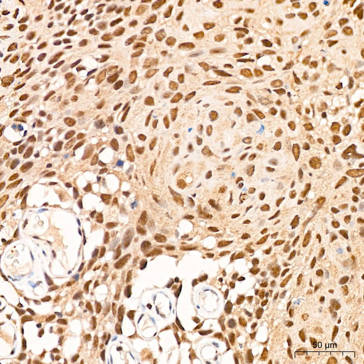 Immunohistochemistry: p70 S6 Kinase beta/S6K2 Antibody (5D8F5) [NBP3-16752] - Immunohistochemistry analysis of p70 S6 Kinase beta/S6K2 in paraffin-embedded human cervix cancer tissue using p70 S6 Kinase beta/S6K2 Rabbit mAb  at a dilution of 1:200 (40x lens). High pressure antigen retrieval was performed with 0.01 M citrate buffer (pH 6.0) prior to IHC staining.